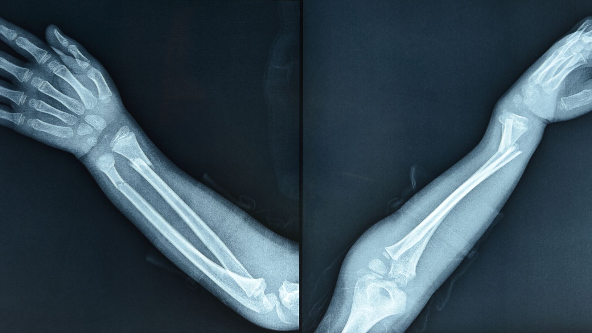 Việc phân loại đúng gãy xương quay tay giúp xác định phương pháp điều trị phù hợp nhất