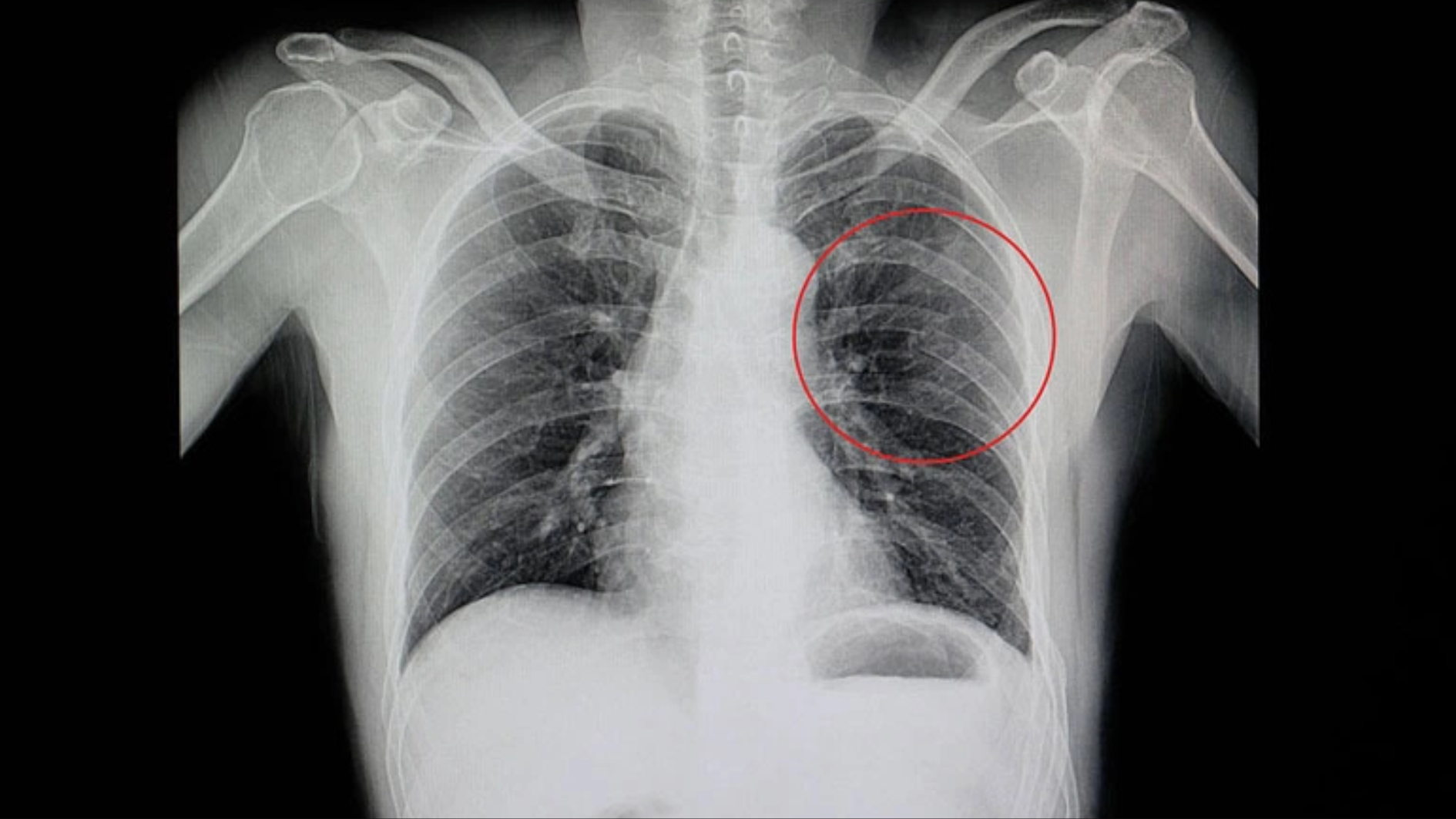 Gãy xương sườn có tự lành không được nhiều người quan tâm