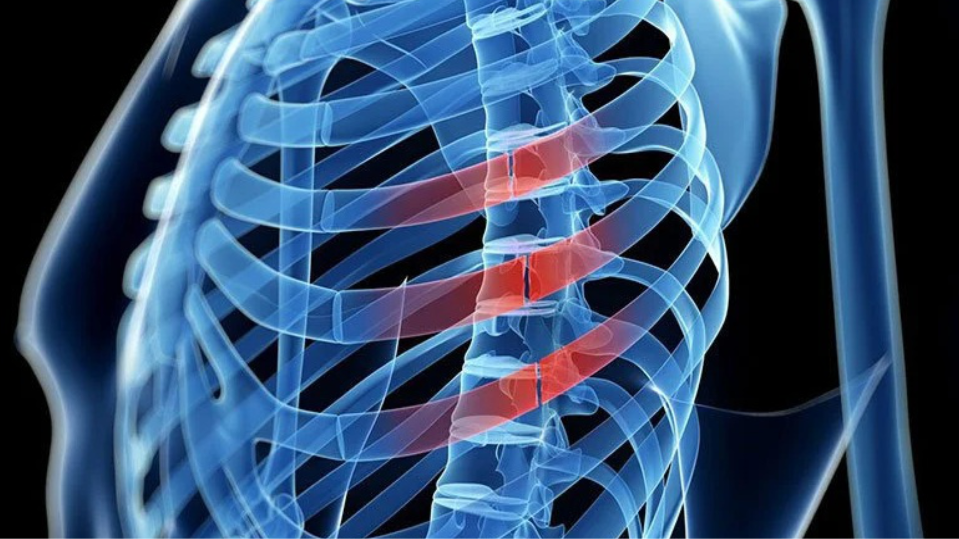 Thời gian hồi phục sau gãy xương sườn tùy thuộc nhiều yếu tố