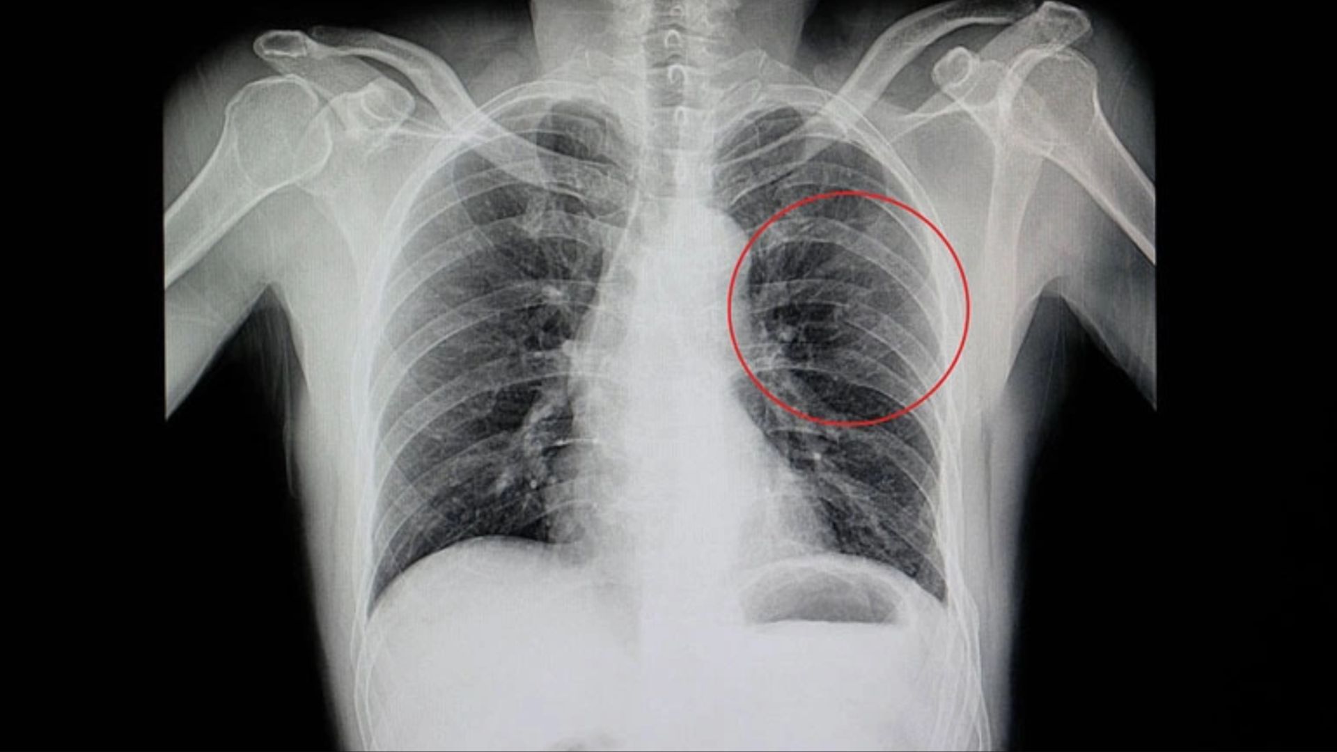 Gãy xương sườn là tình trạng một hoặc nhiều xương trong khung sườn bị nứt hoặc gãy