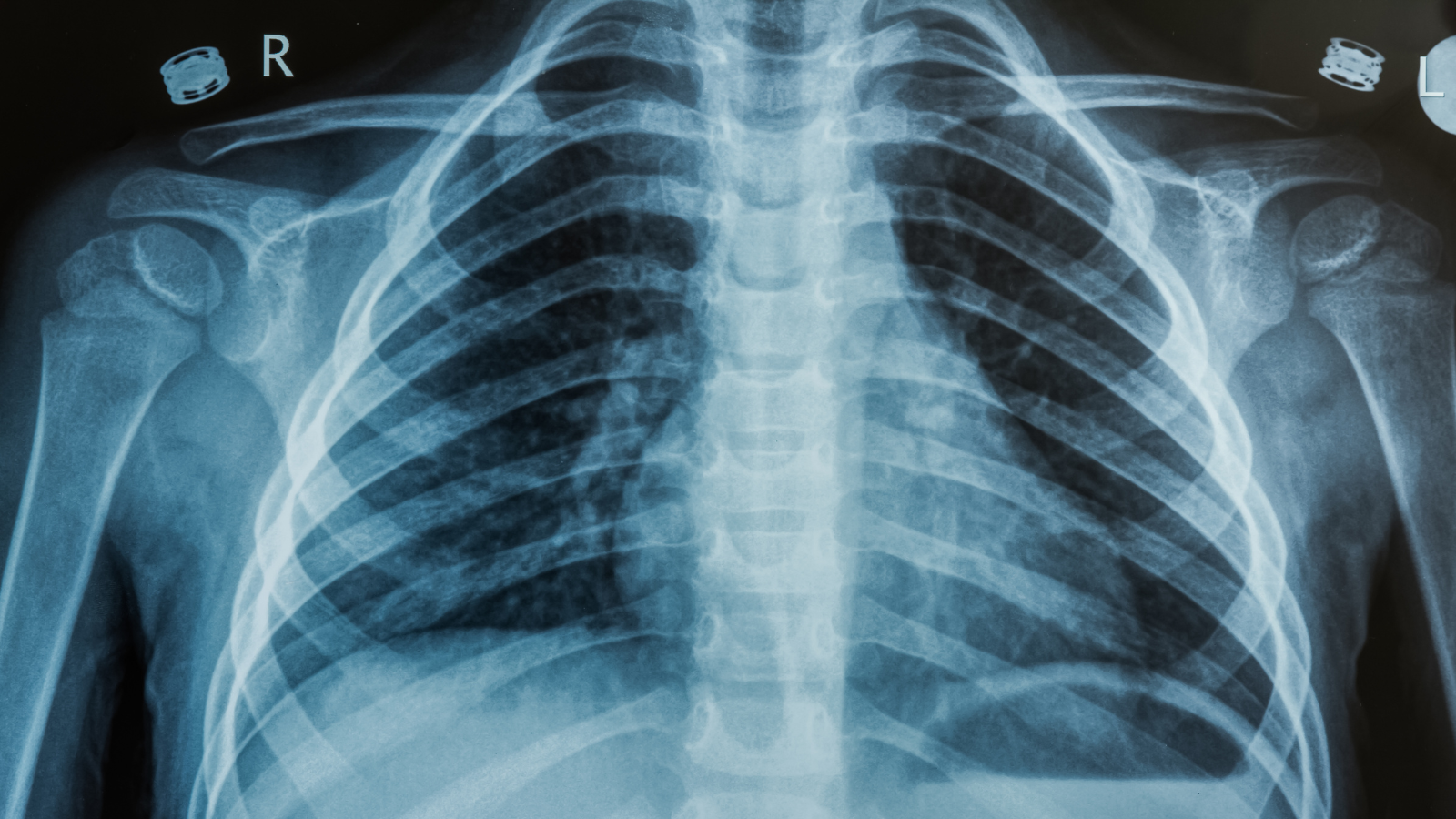 Gãy xương sườn số 5 6 7 gây đau đớn dữ dội và cản trở hoạt động hô hấp