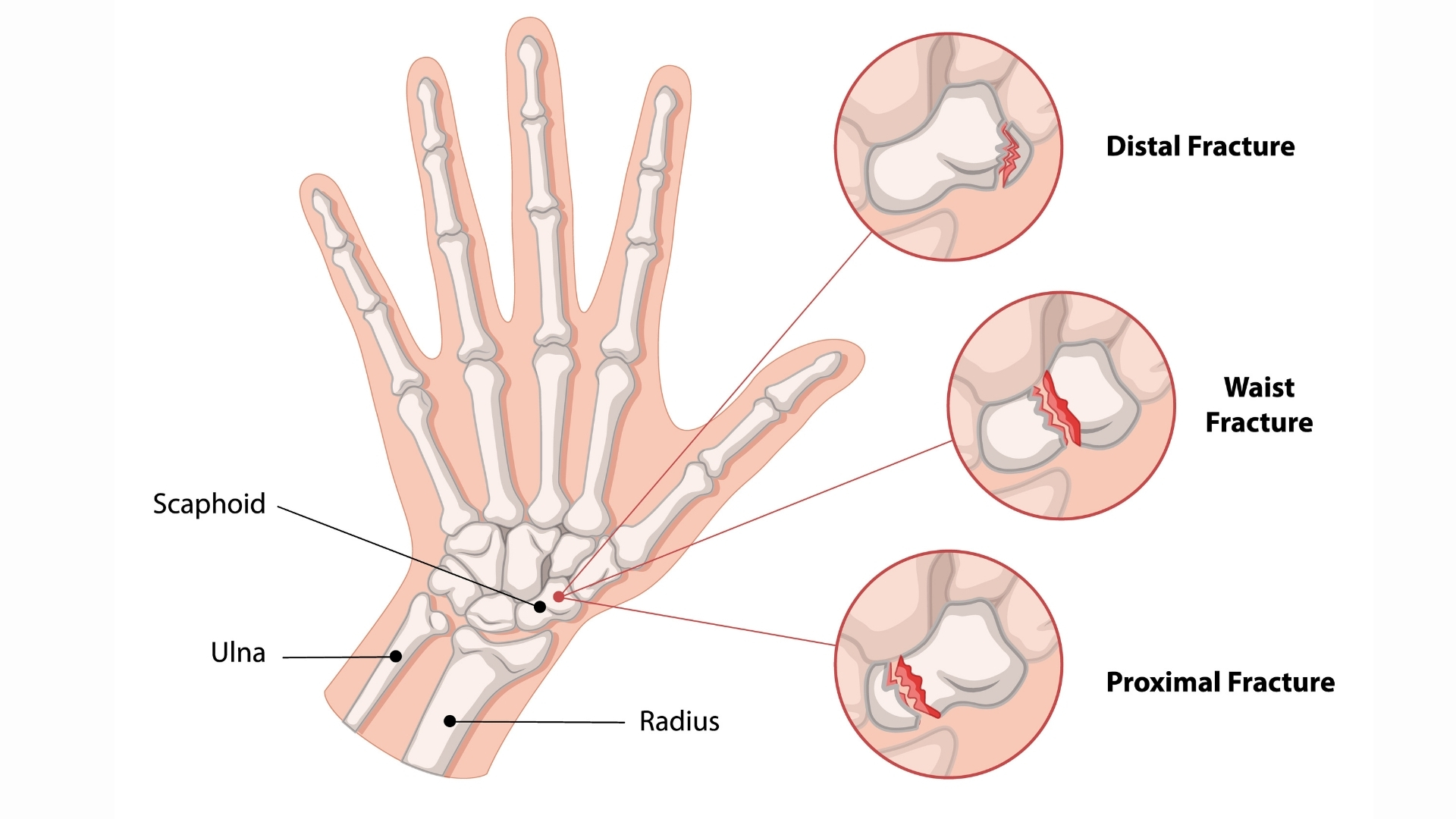 Gãy xương thuyền cổ tay là tình trạng gãy của xương thuyền (scaphoid), một trong tám xương nhỏ tạo nên hàng xương gần của cổ tay, nằm ở phía ngón cái