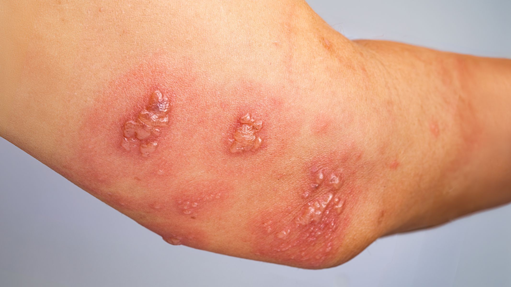 Ghẻ mủ là một dạng bệnh da liễu do ký sinh trùng Sarcoptes scabiei gây ra