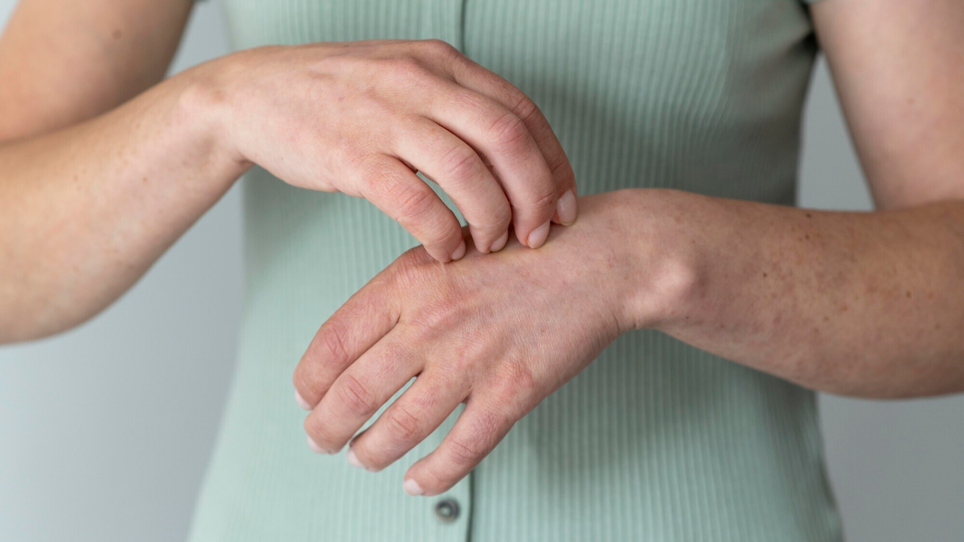Ghẻ nước ở tay là một bệnh da liễu do ký sinh trùng sarcoptes scabiei gây ra