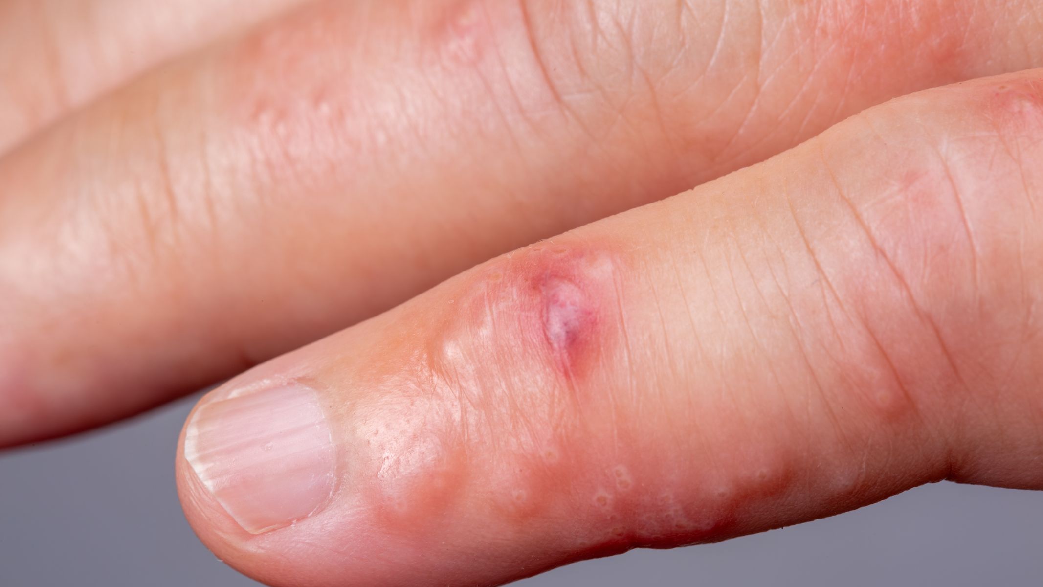 Ghẻ nước và tổ đỉa đều là bệnh lý da liễu đặc trưng bởi sự xuất hiện của mụn nước kèm ngứa ngáy dữ dội, dễ gây nhầm lẫn trong chẩn đoán lâm sàng