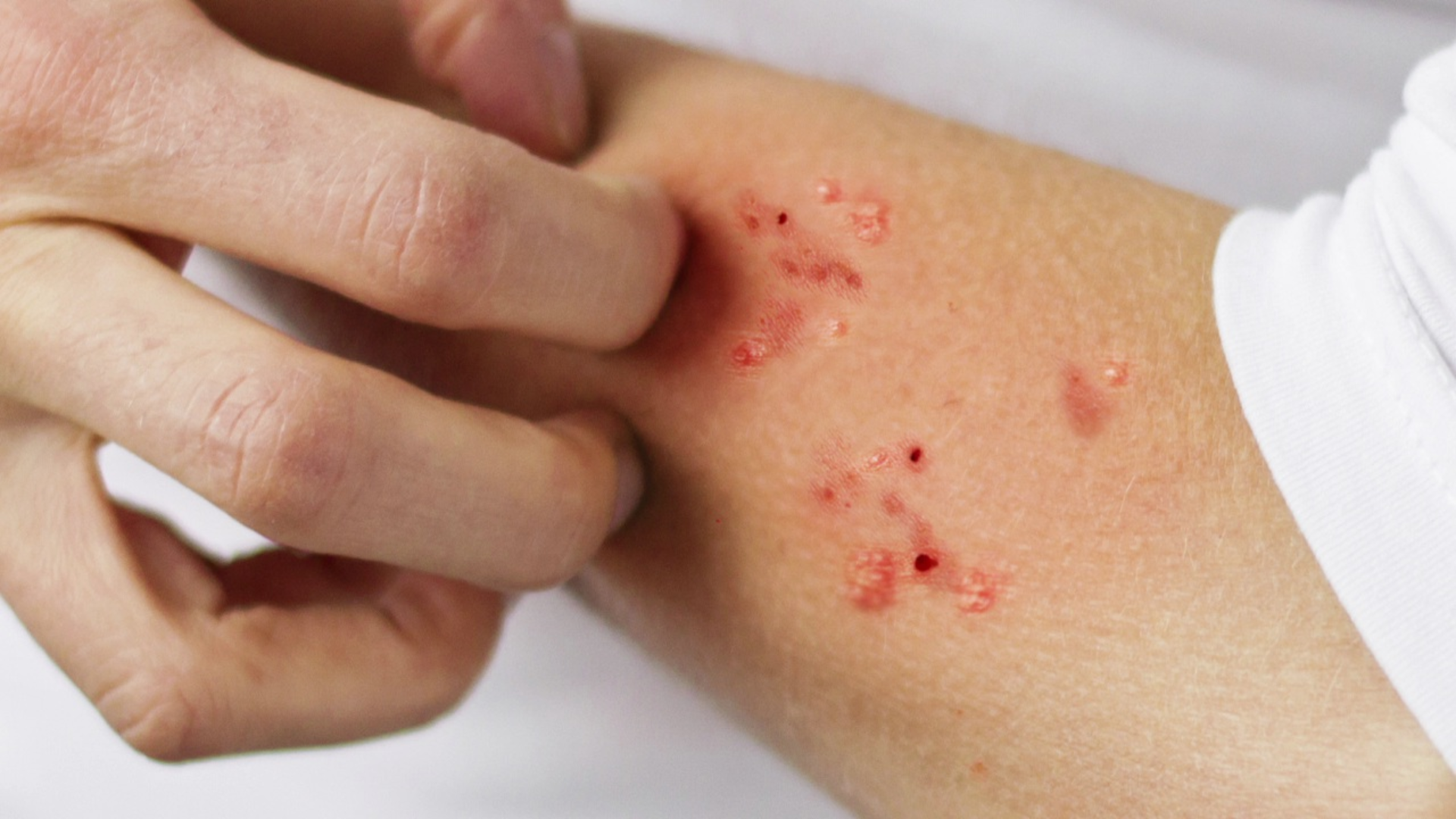 Việc điều trị tùy tình trạng mỗi người, nhưng luôn cần nhớ không gãi hoặc bóc vảy để bảo vệ da