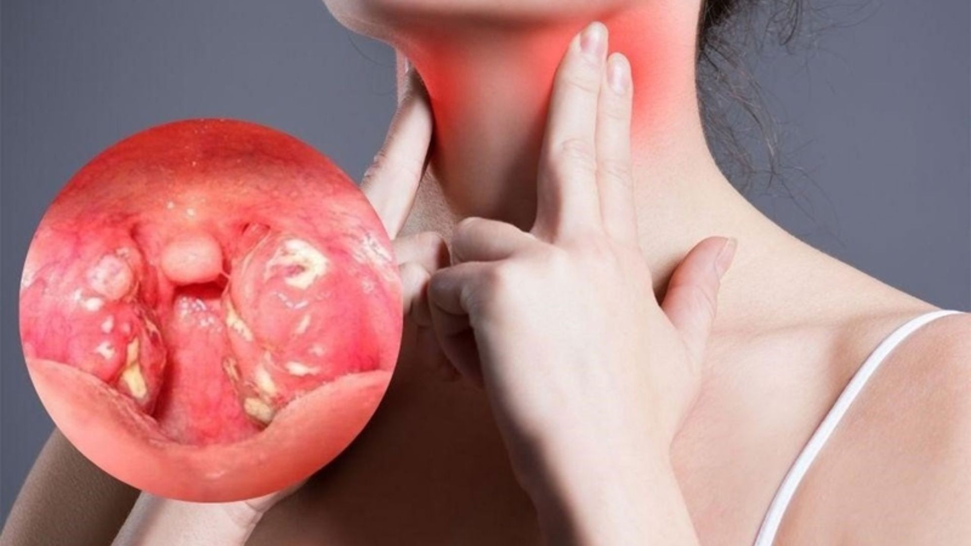 Giả mạc sau khi cắt amidan xuất hiện là dấu hiệu cho thấy vết mổ đang dần hồi phục