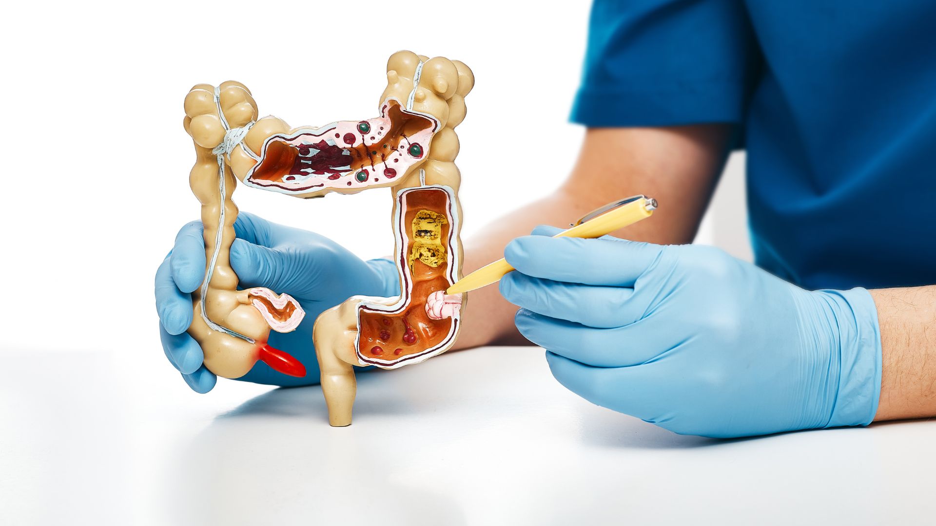 Giải đáp chi phí cắt polyp đại tràng và các yếu tố quyết định 1