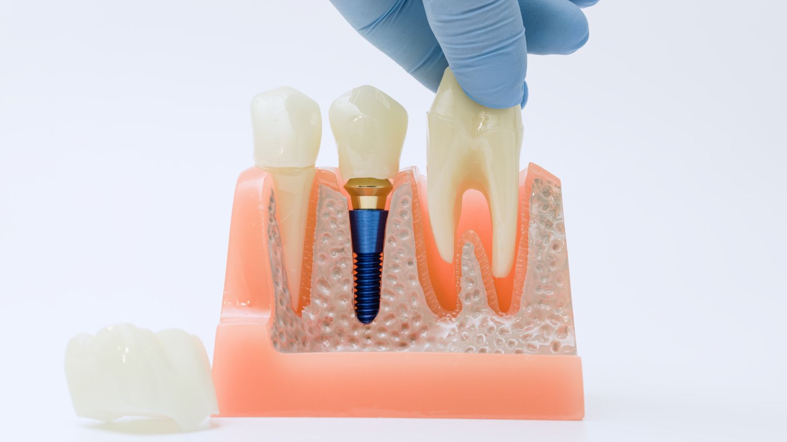 Thực tế, chi phí nhổ răng khôn không có một mức cố định chung cho tất cả mọi trường hợp