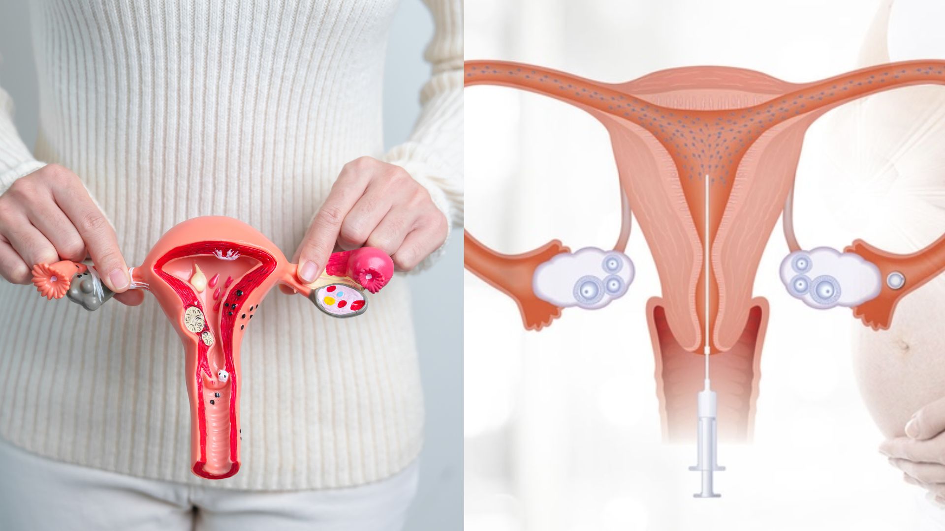 Vòi trứng thông hạn chế có làm IUI được không là băn khoăn của nhiều cặp đôi