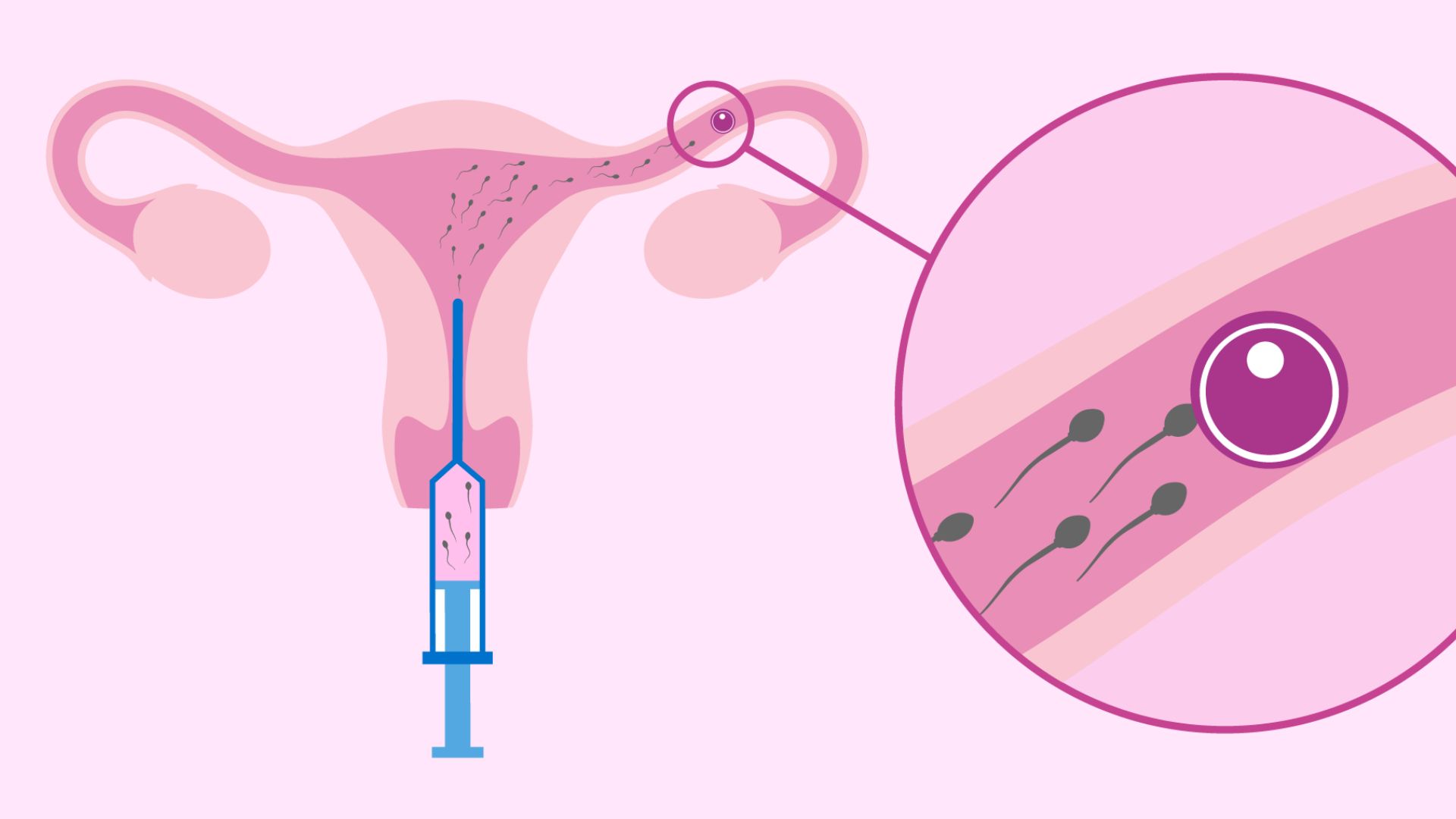 IUI thường được chỉ định trong trường hợp vòi trứng thông hạn chế nhẹ