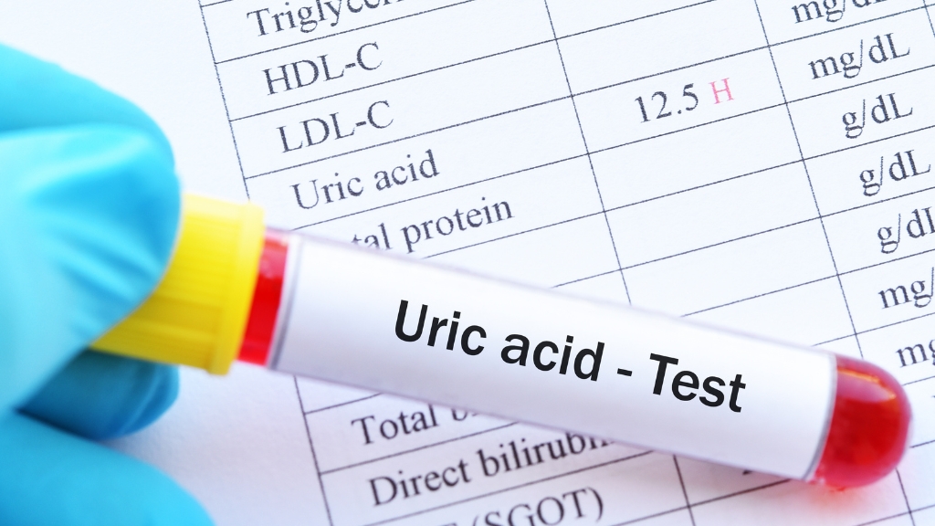 Xét nghiệm máu kiểm tra acid uric là bước quan trọng để phát hiện nguy cơ gút