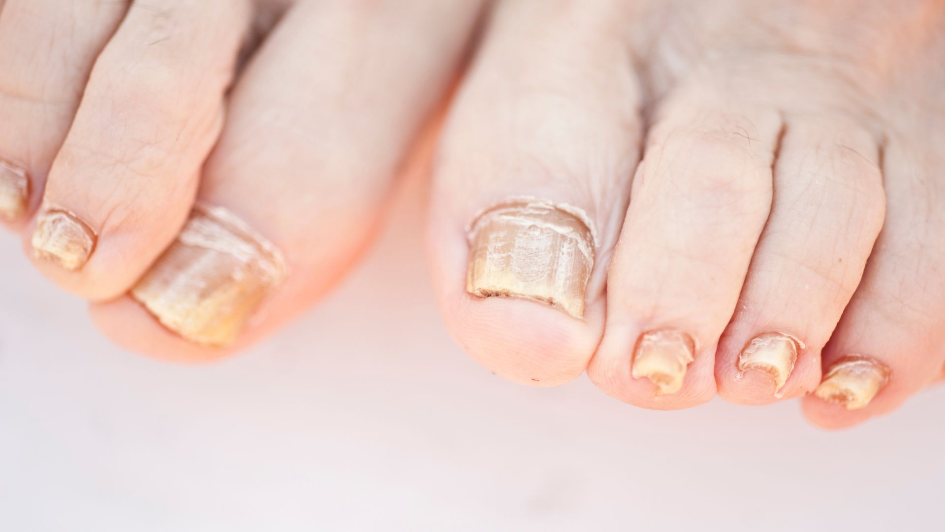 Nấm móng chân là một bệnh lý phổ biến