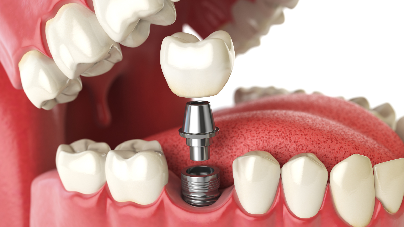 Y học hiện đại khai thác răng hàm mặt trong các công nghệ tiên tiến như cấy ghép implant và tái tạo xương