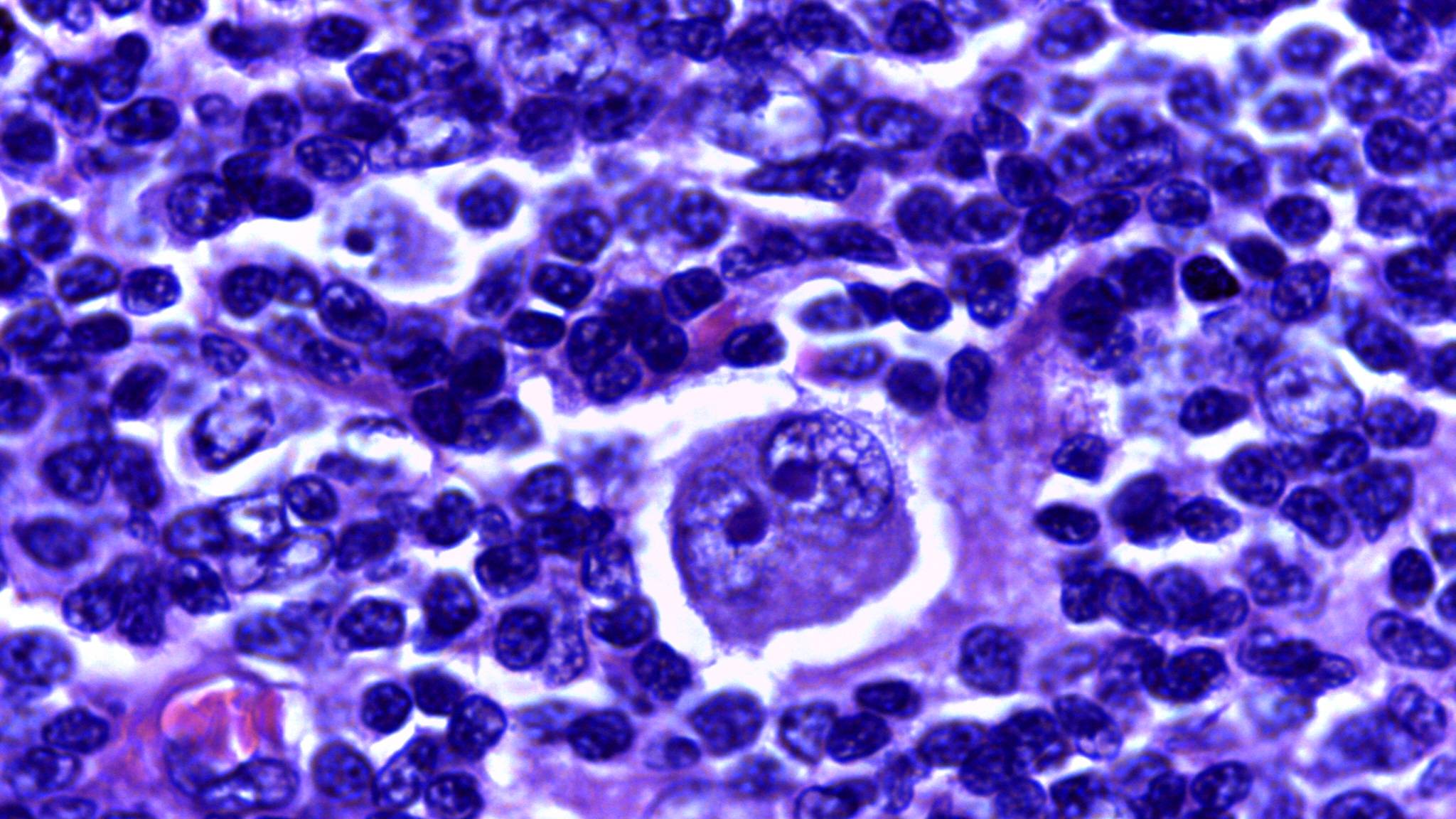 Bệnh giảm tiểu cầu có thể làm tăng nguy cơ mắc các bệnh ác tính về máu như u lympho Hodgkin