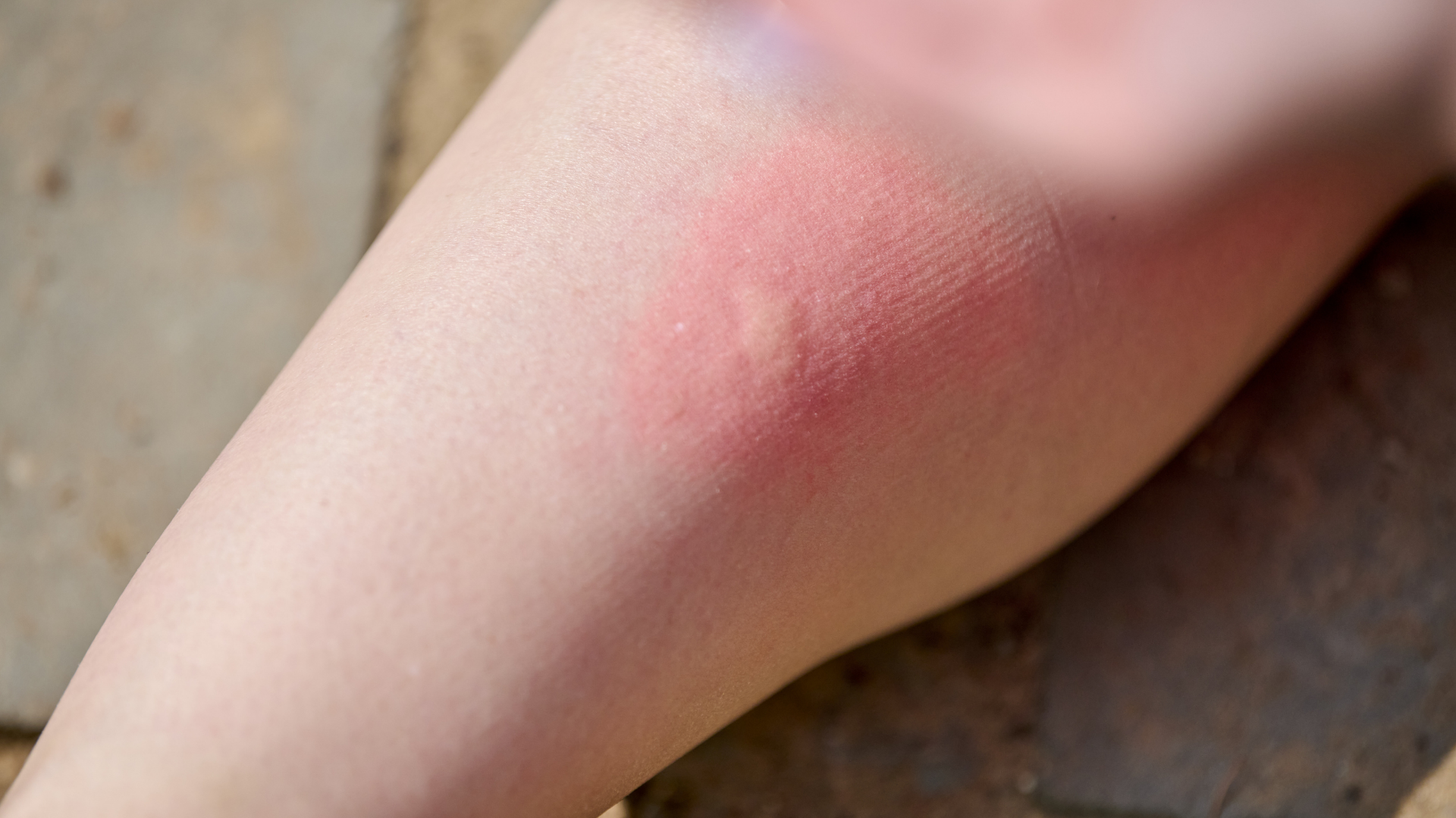 Một vết cắn từ gián cần được theo dõi để tránh nhiễm trùng và viêm