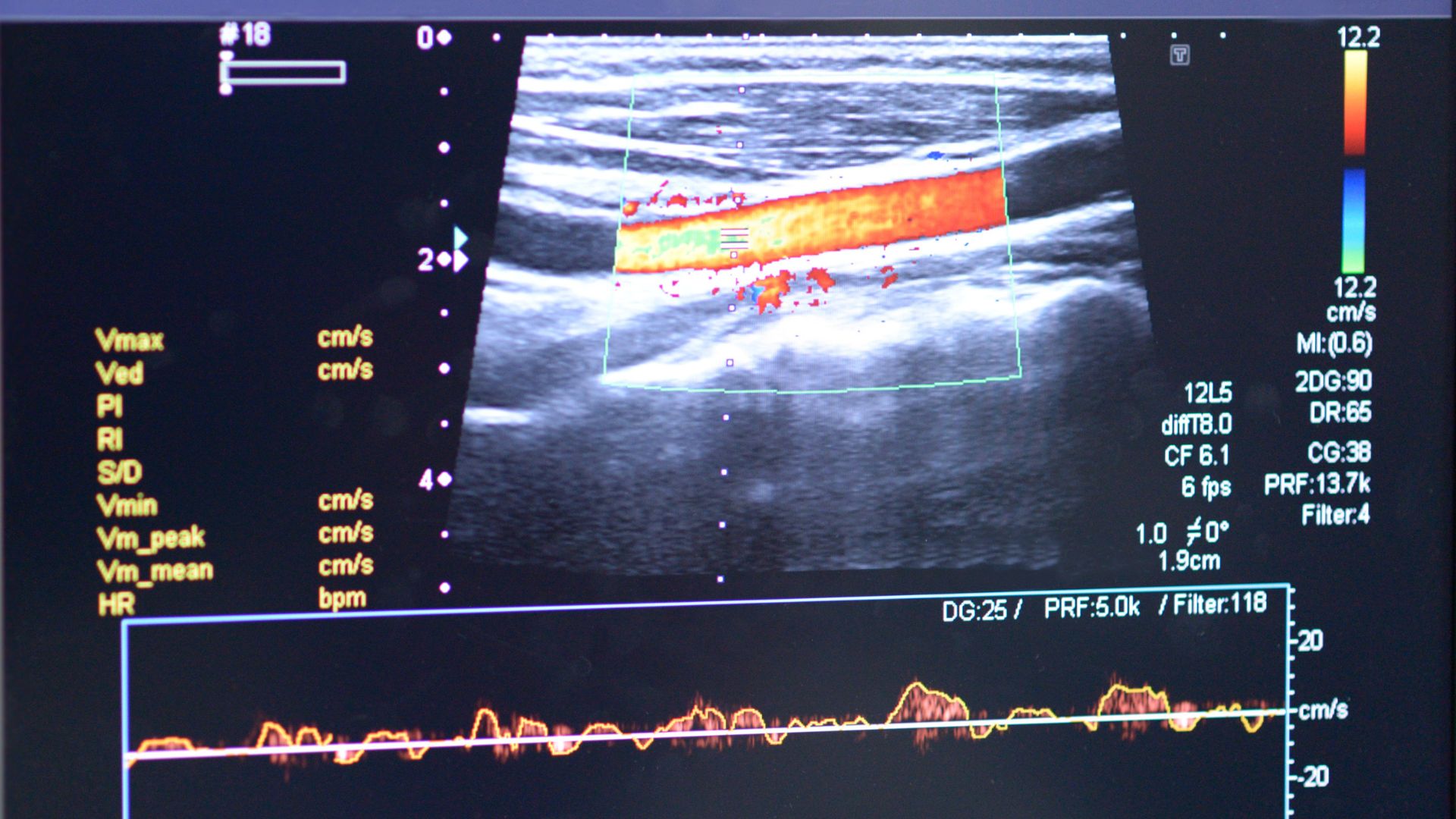 Siêu âm Doppler mạch máu để đánh giá bất thường mạch và suy tĩnh mạch