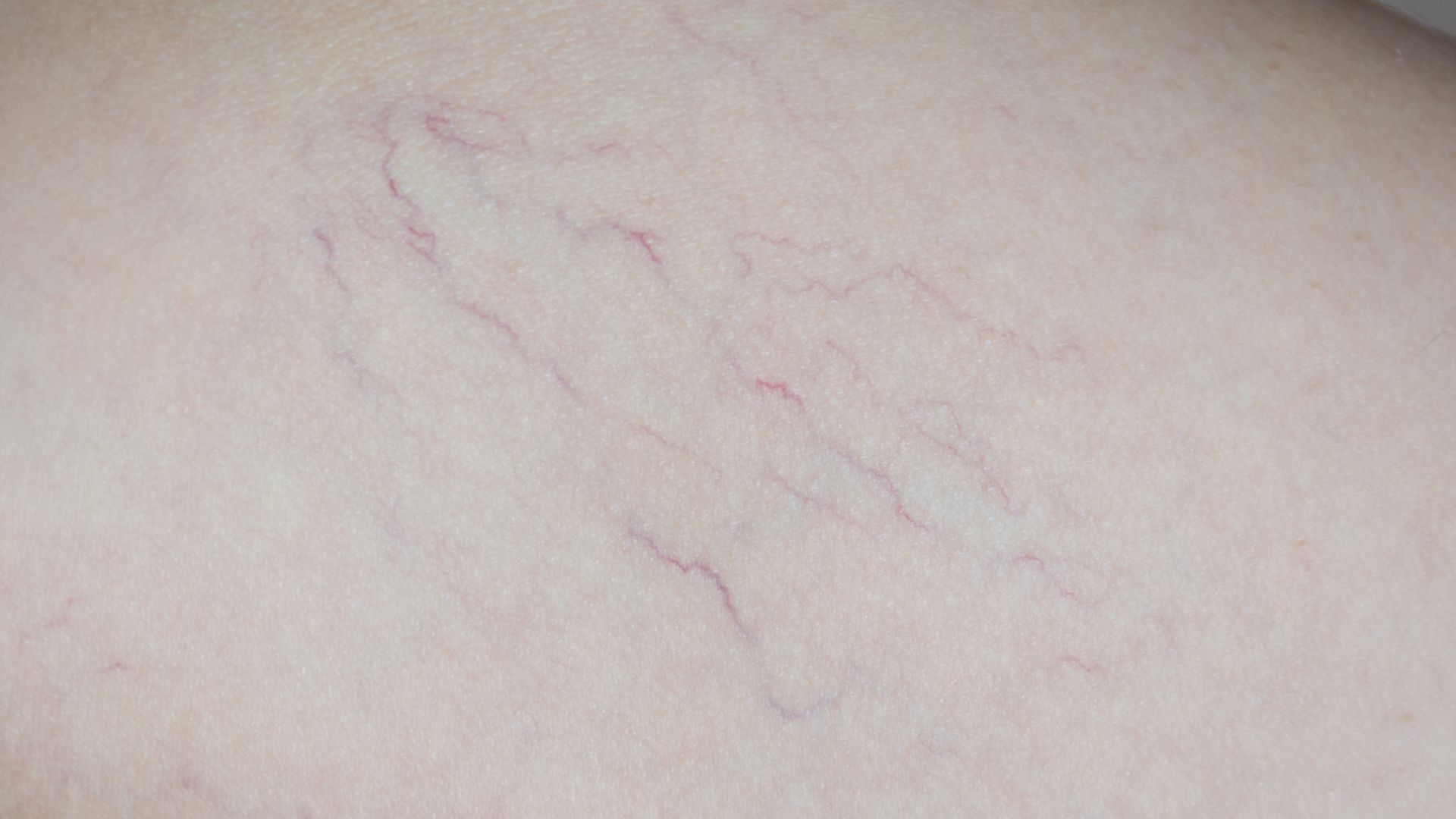 Xuất hiện các mạch máu nhỏ giãn nở nhìn thấy rõ trên da hoặc niêm mạc, màu đỏ, hồng hoặc tím.