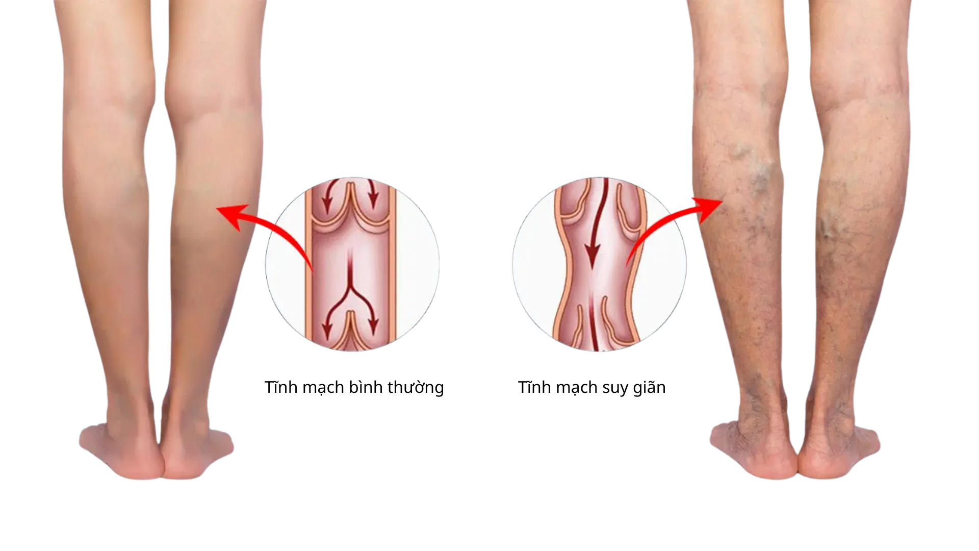 Giãn tĩnh mạch ngoằn ngoèo