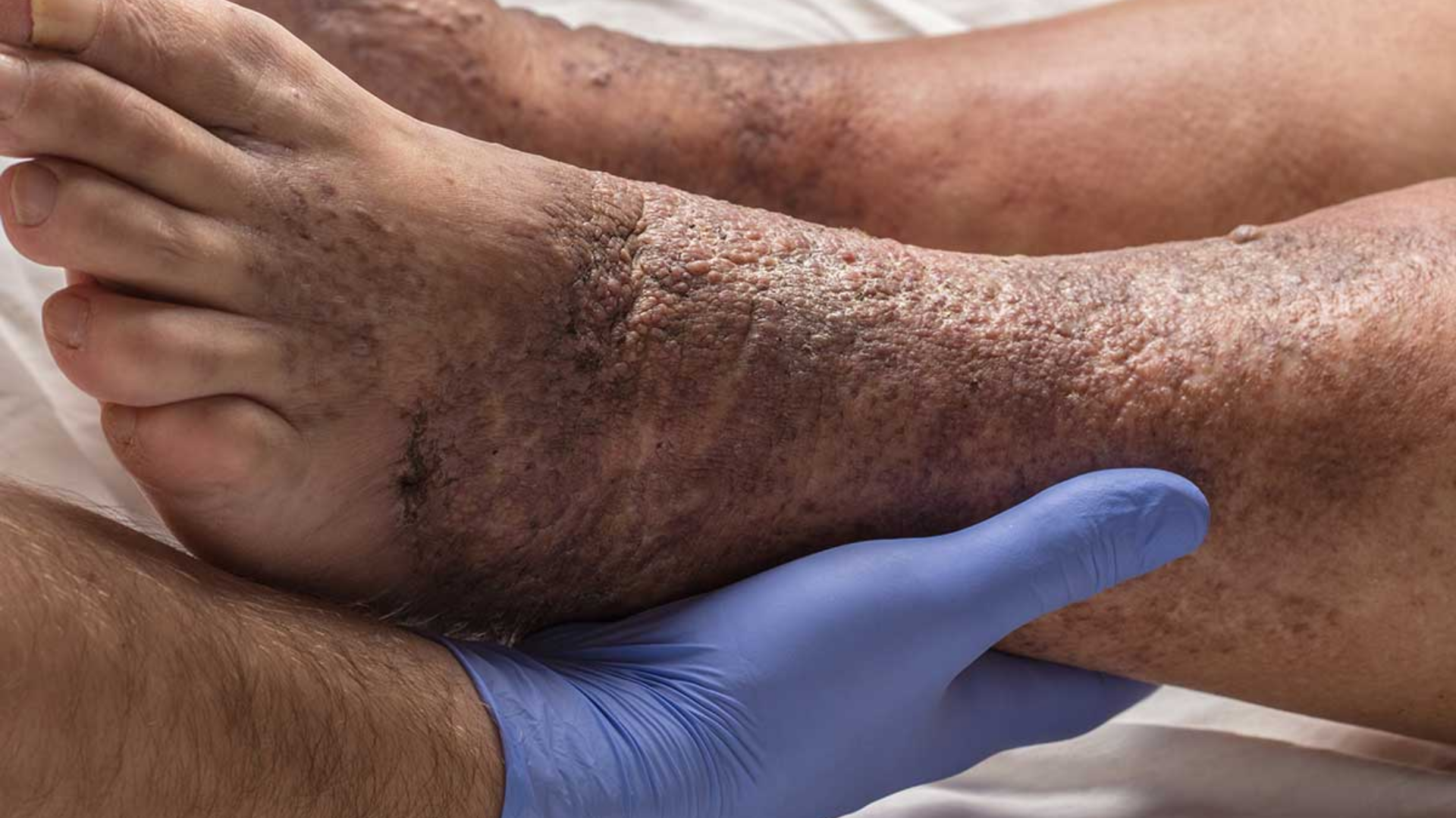 Thay đổi màu sắc da trong giãn tĩnh mạch