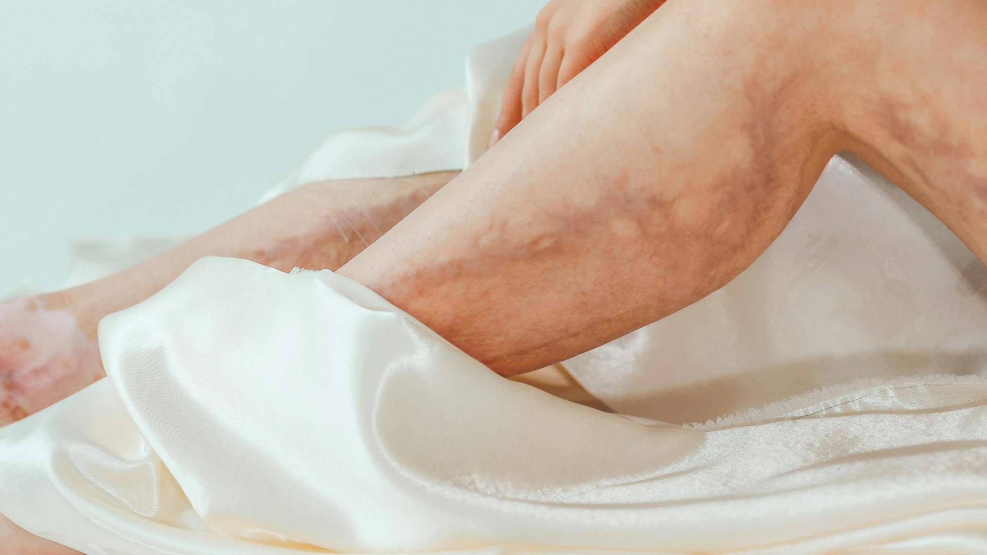 Khám sớm giúp phát hiện giãn tĩnh mạch và phòng ngừa biến chứng hiệu quả