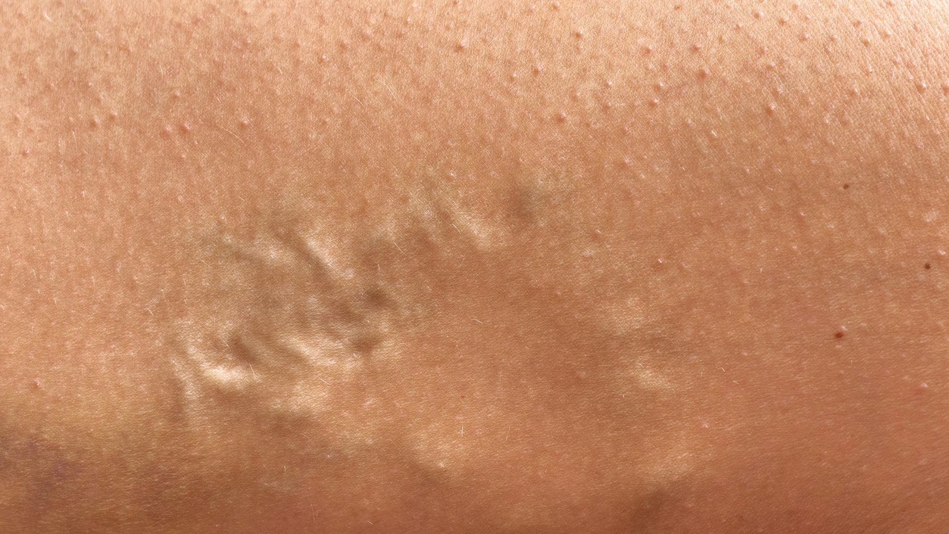 Giãn tĩnh mạch tay xảy ra chủ yếu do van tĩnh mạch suy yếu khiến máu ứ đọng cùng các yếu tố khác