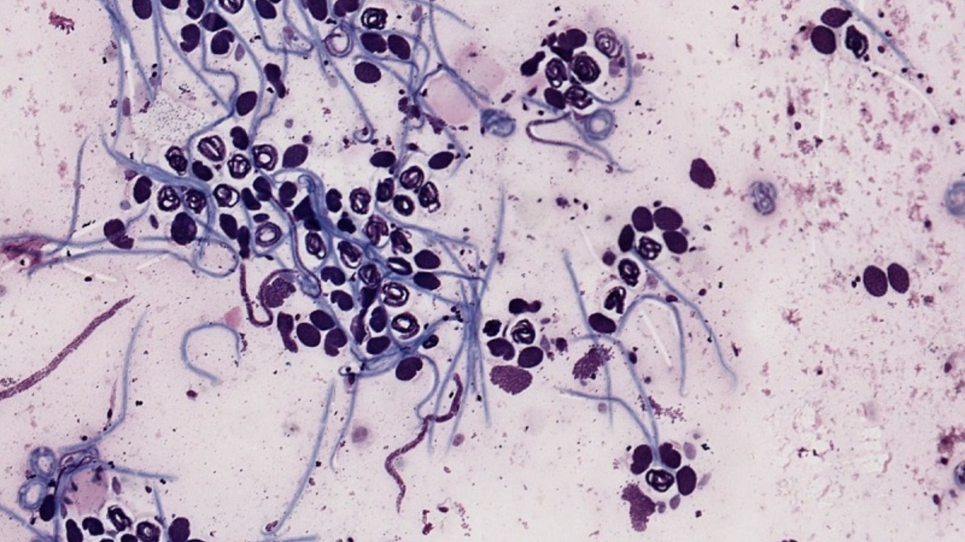 Bệnh giun chỉ là một trong các bệnh nhiễm ký sinh trùng vô cùng nguy hiểm