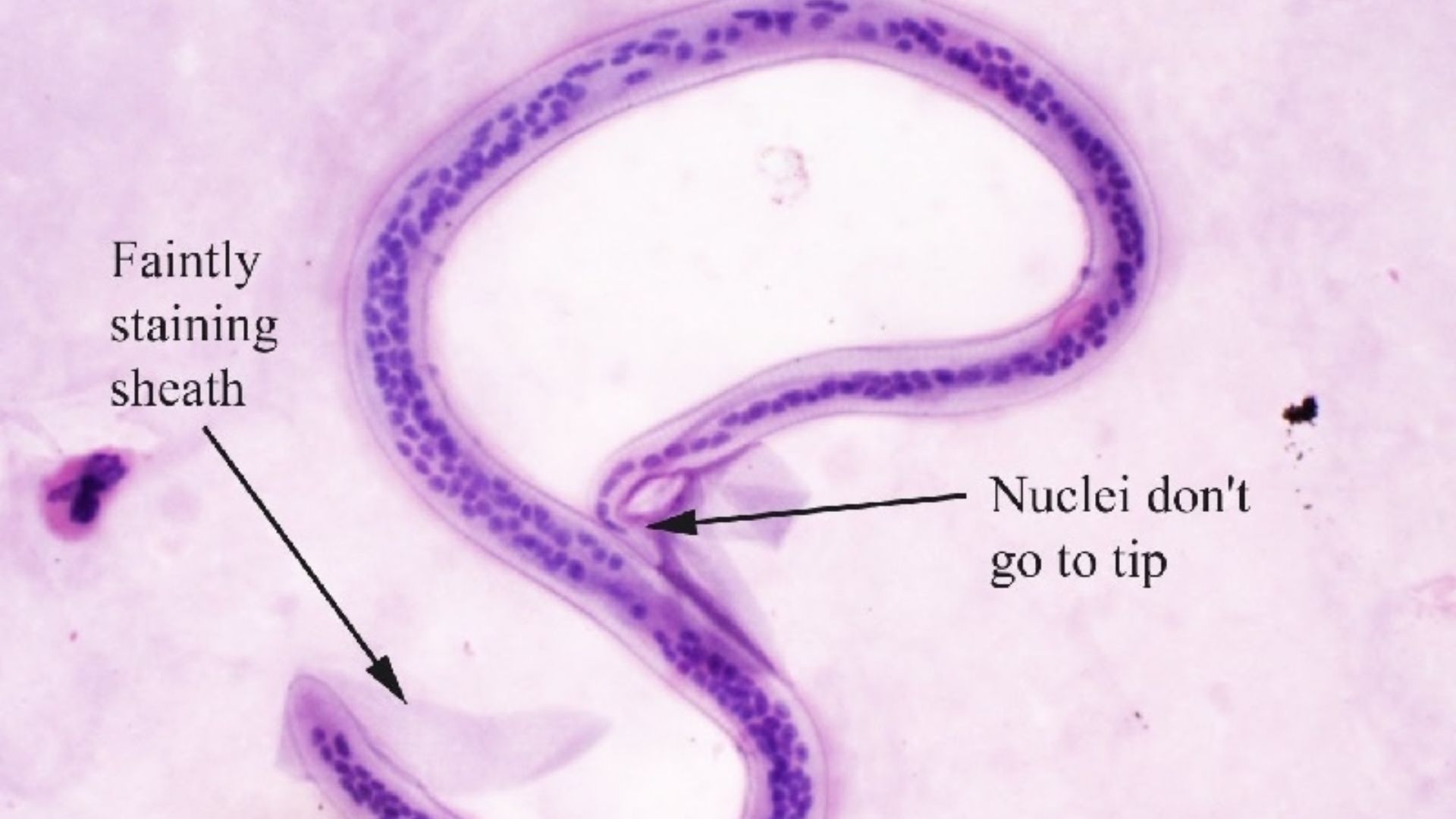 Wuchereria bancrofti là loại giun chỉ gây bệnh ở người phổ biến nhất