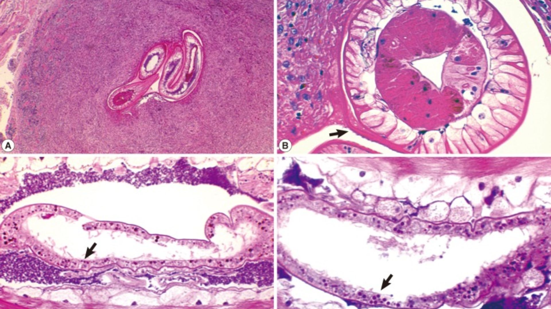Bệnh giun đầu gai là căn bệnh gây ra bởi ấu trùng giun tròn thuộc chi Gnathostoma