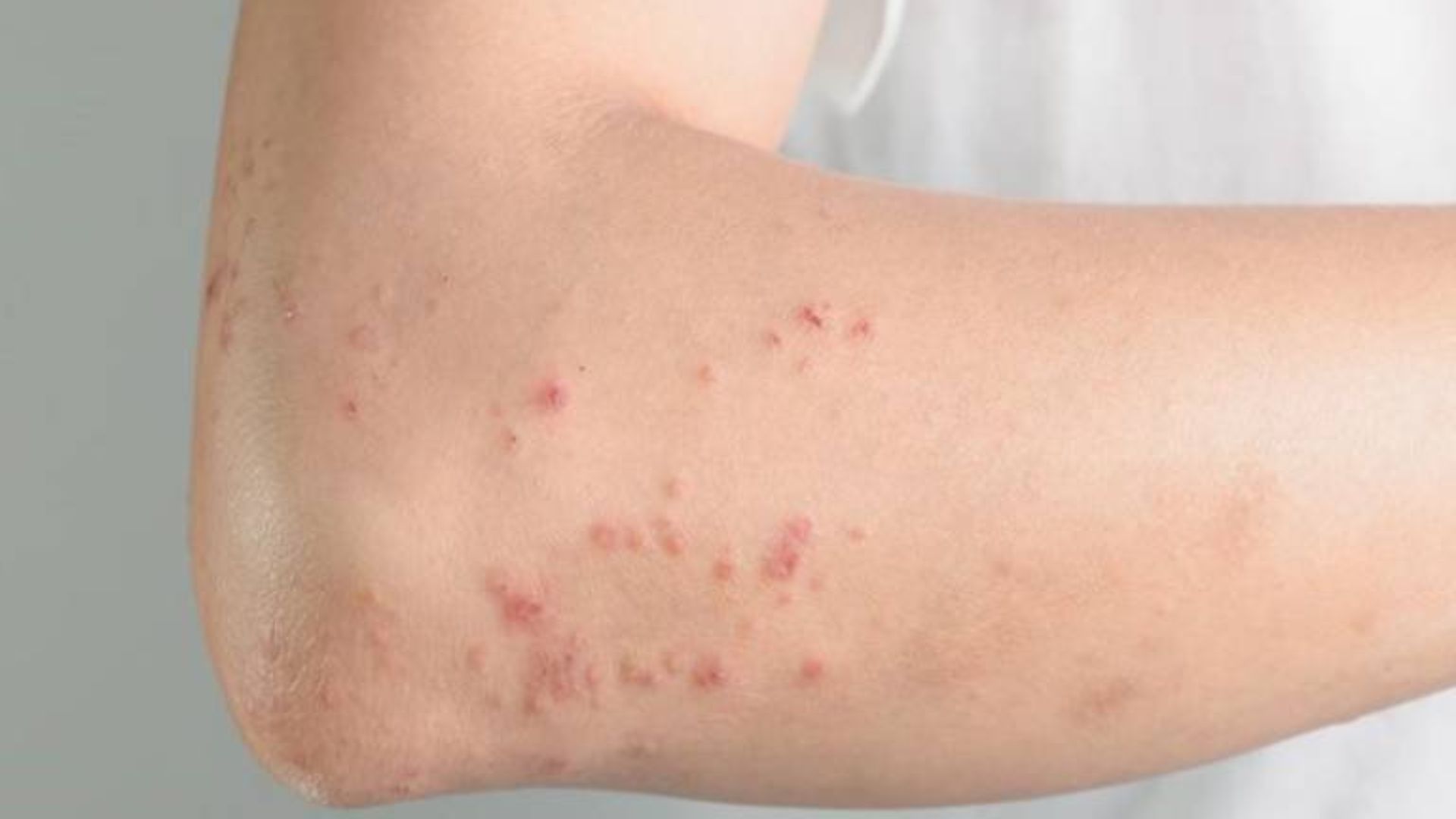 Sự xuất hiện các nốt sưng đỏ dưới da và ngứa là dấu hiệu cảnh báo bệnh giun đầu gai