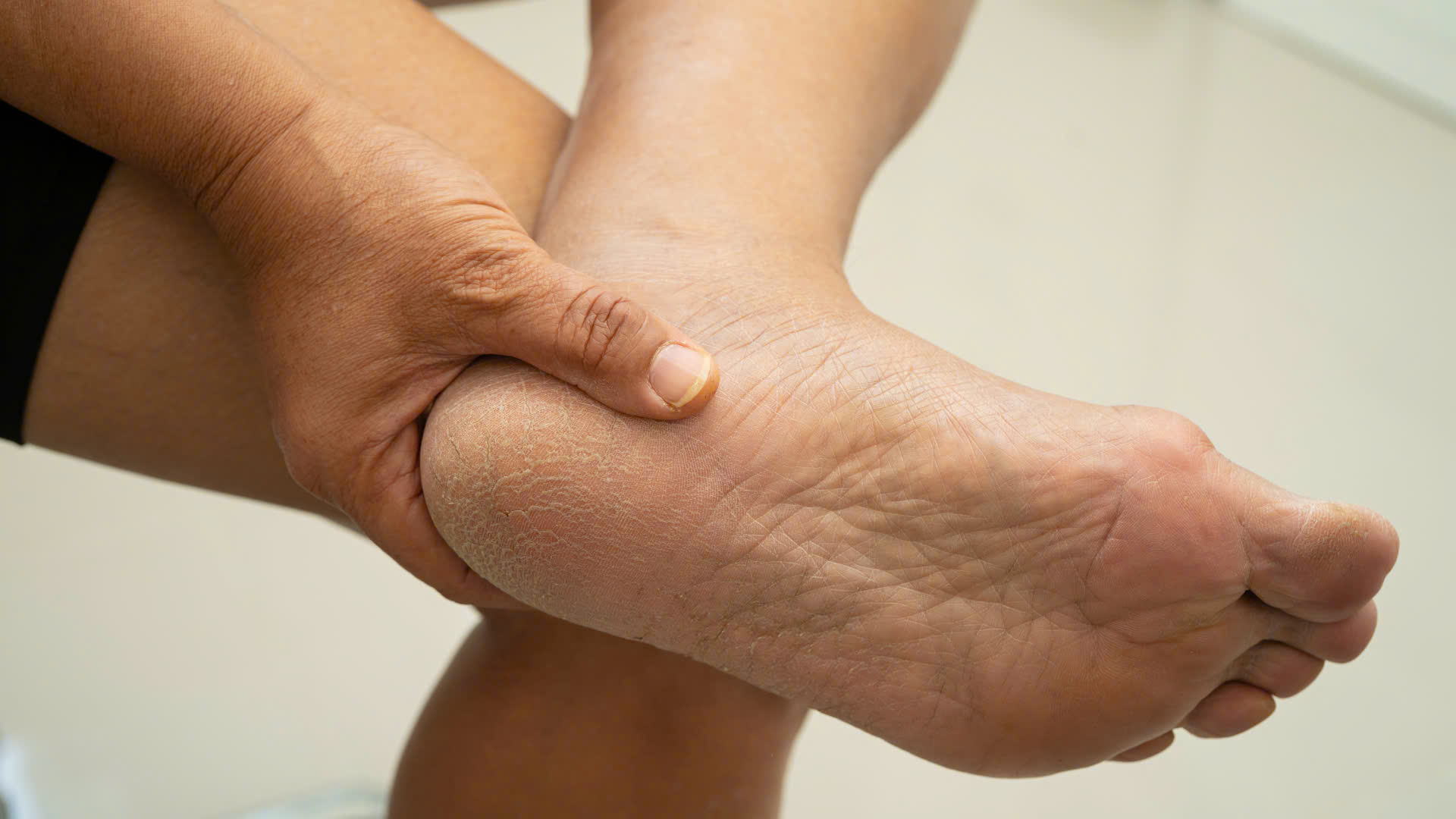 Một số tổn thương ở gân Achilles có thể ảnh hưởng đến khả năng vận động