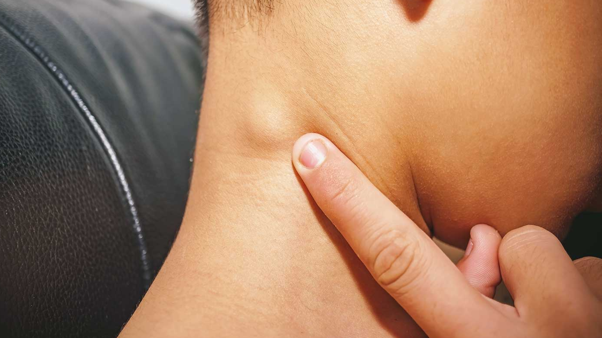 Hạch lành tính là tình trạng hạch sưng to do cơ thể chống lại viêm nhiễm, nhiễm trùng