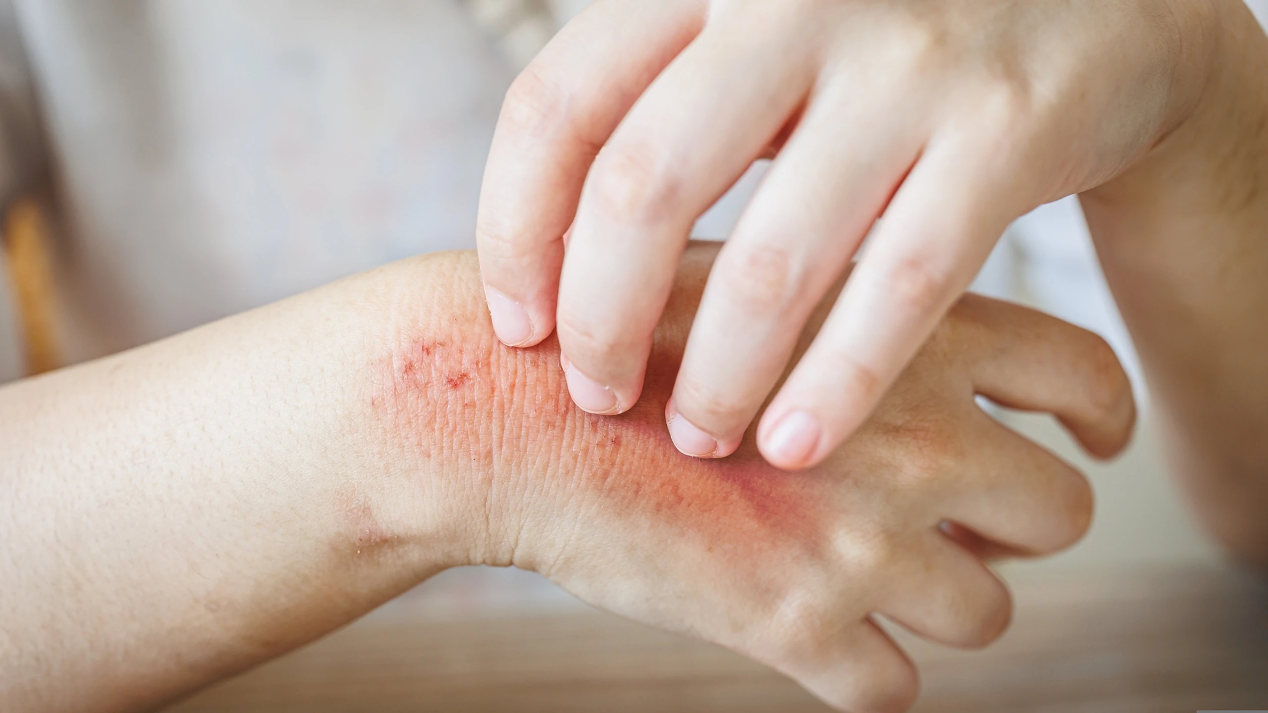 Nguyên nhân phổ biến gây nổi hạch lành tính bao gồm nhiễm trùng da
