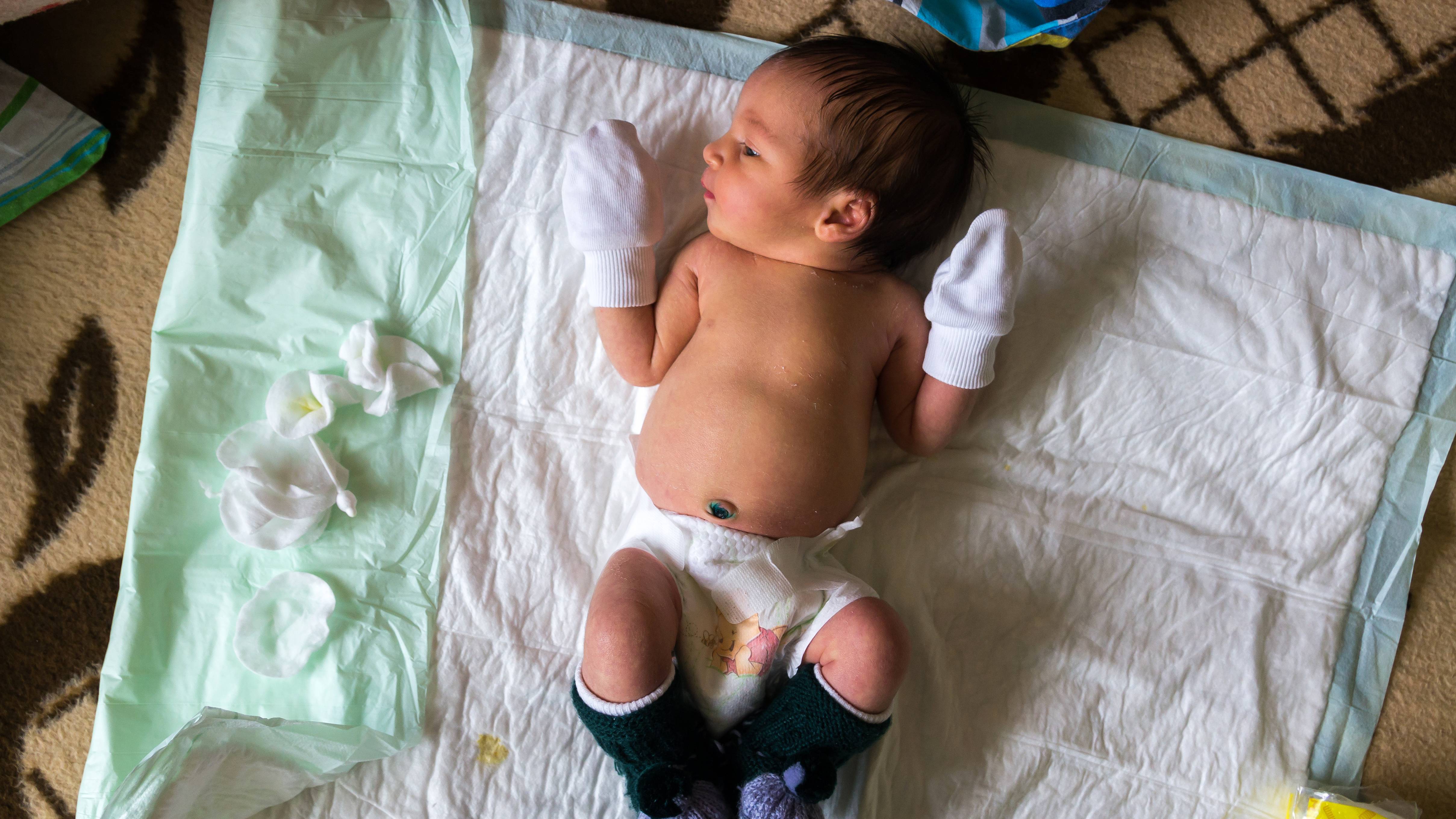 "Hăm tã bao lâu thì khỏi?" là thắc mắc thường gặp của nhiều phụ huynh có con nhỏ