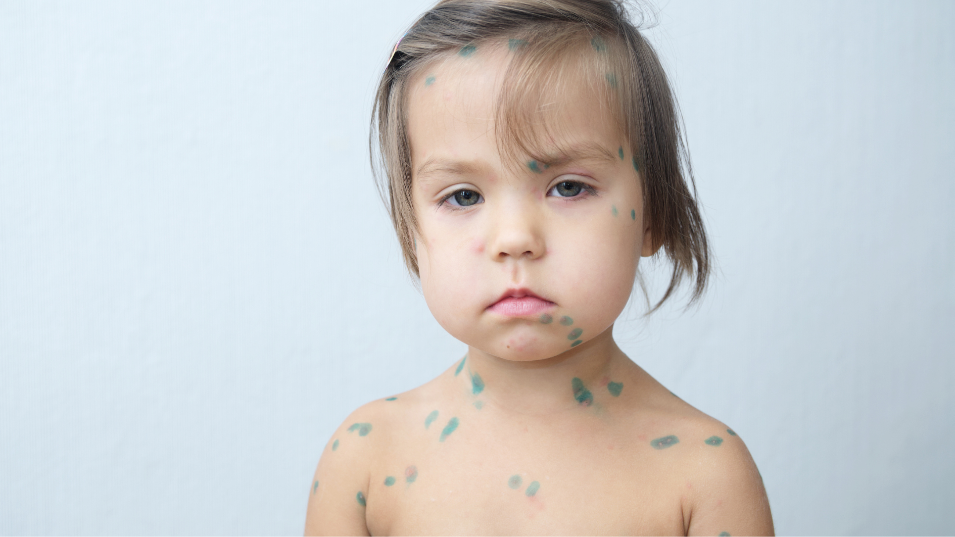 han-che-bung-dich-thuy-dau (3).png