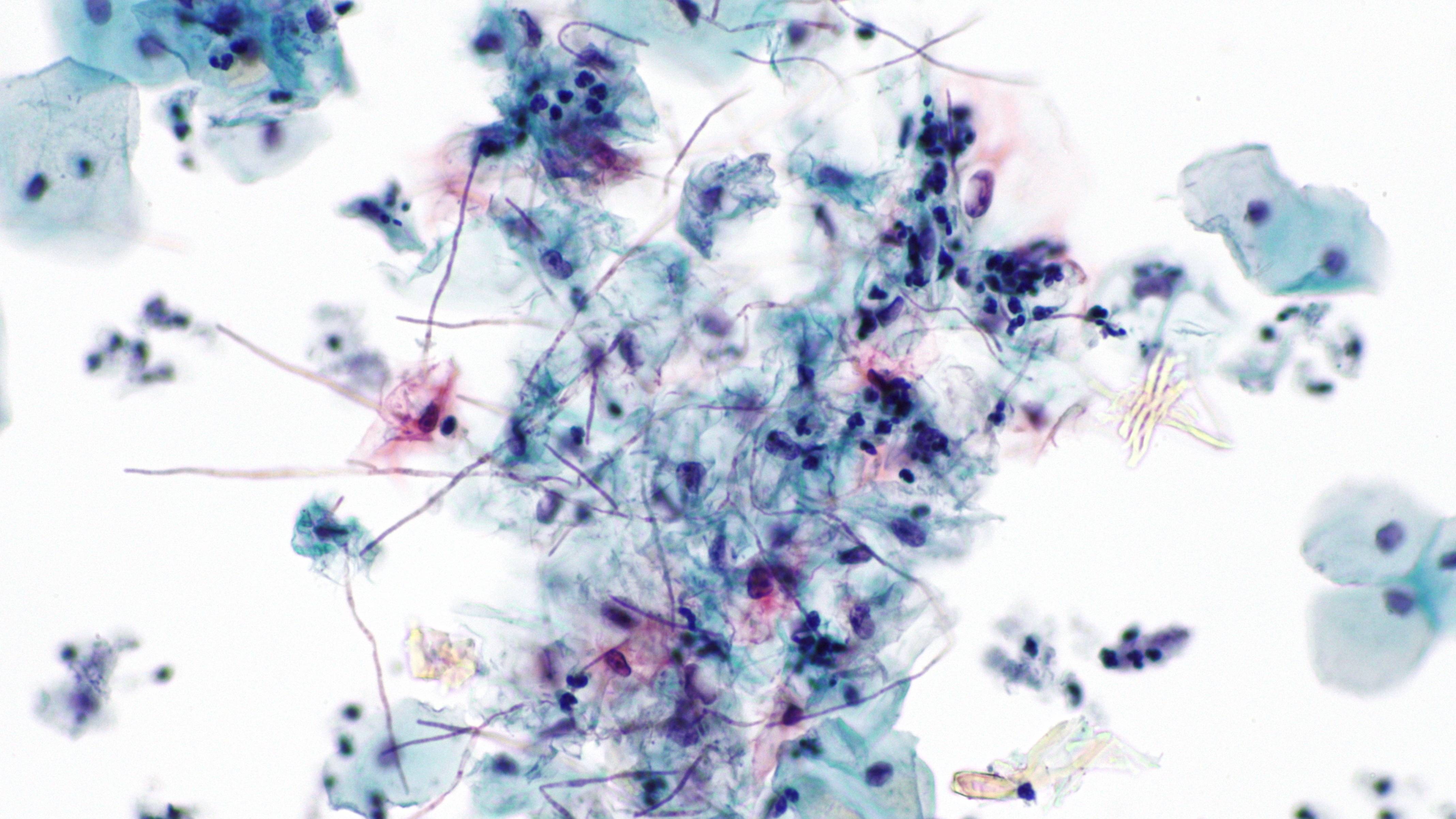 Xét nghiệm Pap smear là một trong các xét nghiệm sàng lọc quan trọng