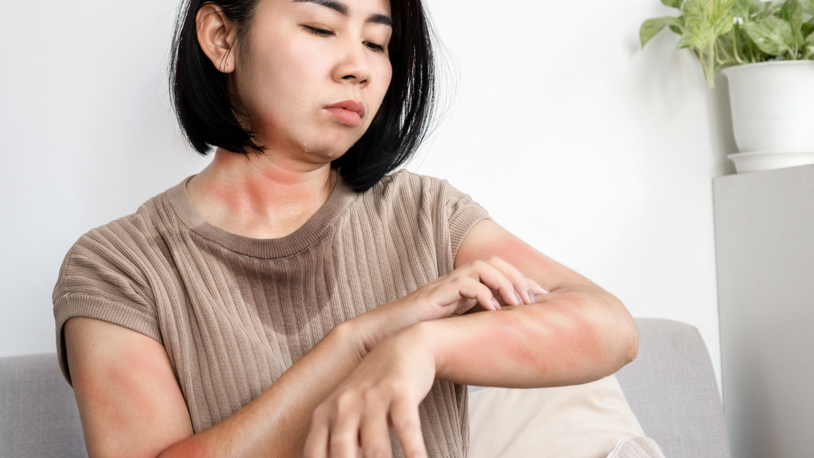 Hay bị mẩn ngứa mùa hè: Nguyên nhân và cách xử trí 1