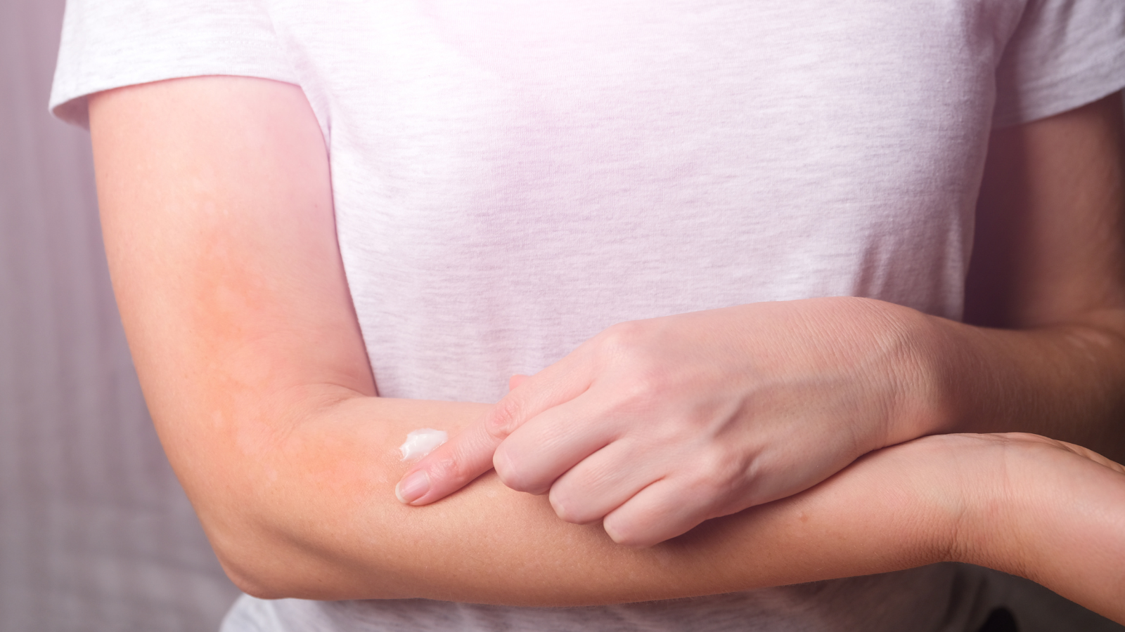 Hay bị mẩn ngứa mùa hè: Nguyên nhân và cách xử trí 4