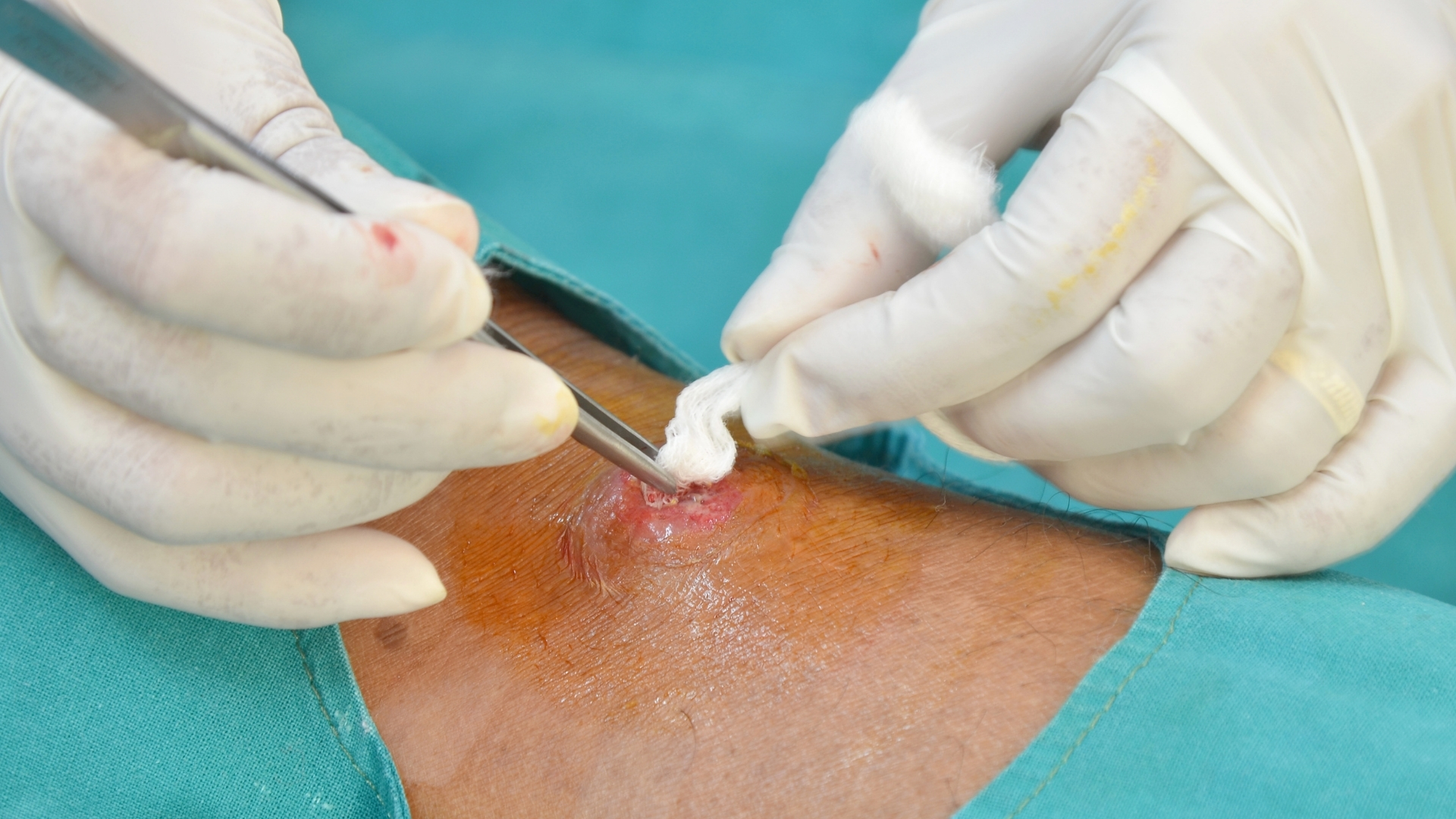 Vệ sinh vùng da bị mụn nhọt hằng ngày bằng nước sạch hoặc dung dịch sát khuẩn nhẹ giúp loại bỏ vi khuẩn và giảm nguy cơ nhiễm trùng