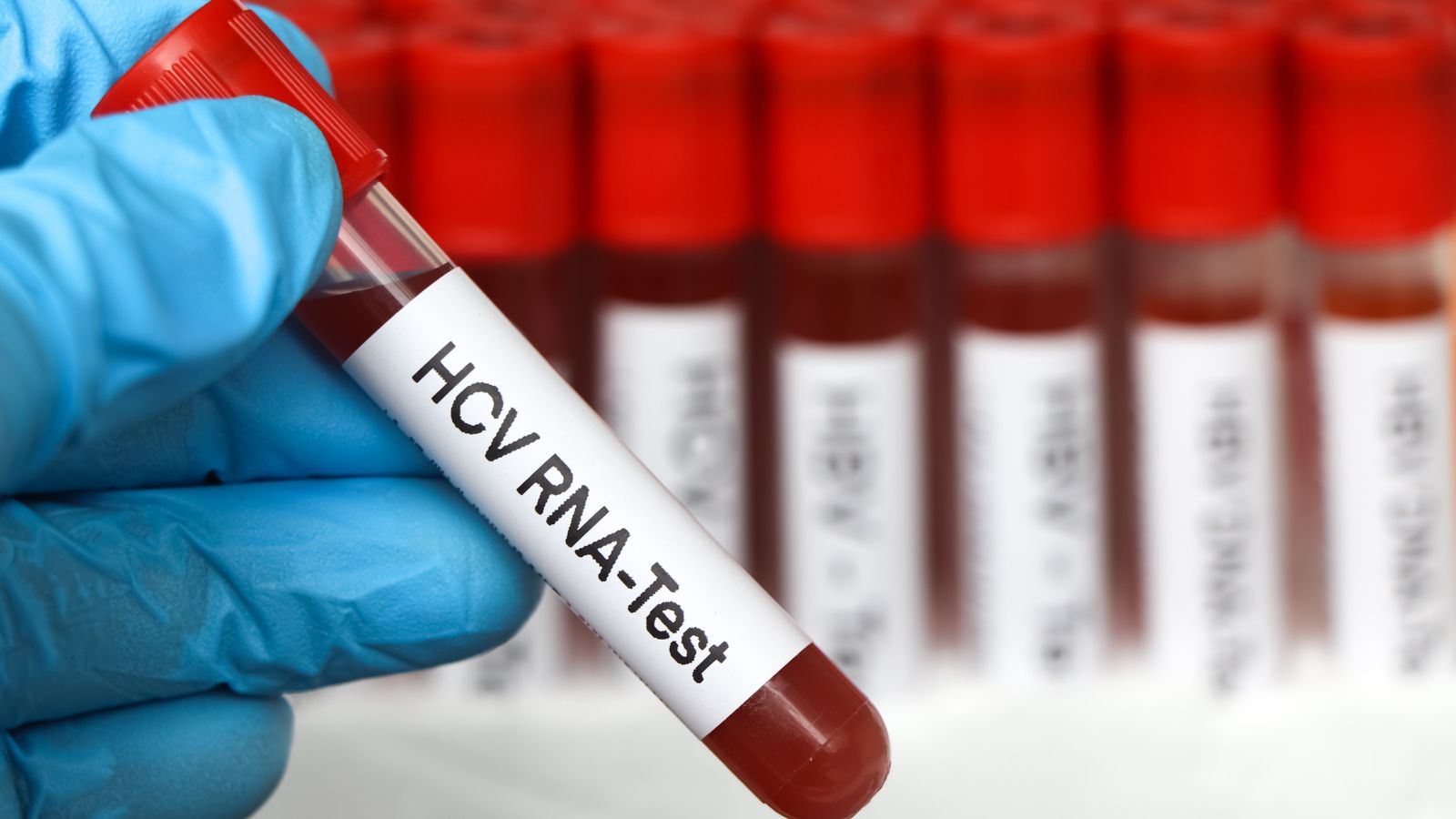 Bác sĩ thường chỉ định xét nghiệm HCV RNA trong một số trường hợp