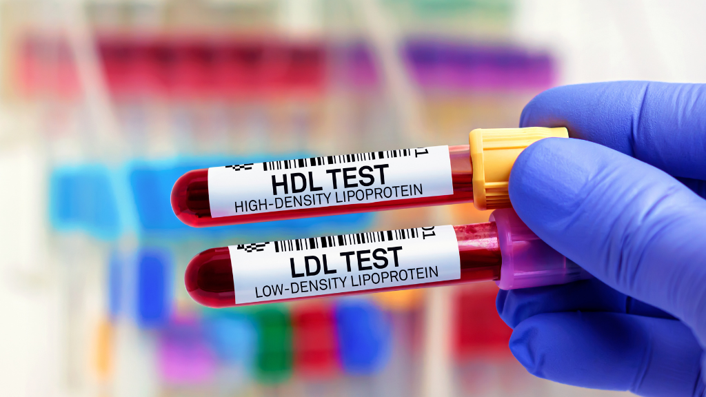 HDL và LDL là hai loại cholesterol quan trọng nhưng có tác động trái ngược đến sức khỏe tim mạch