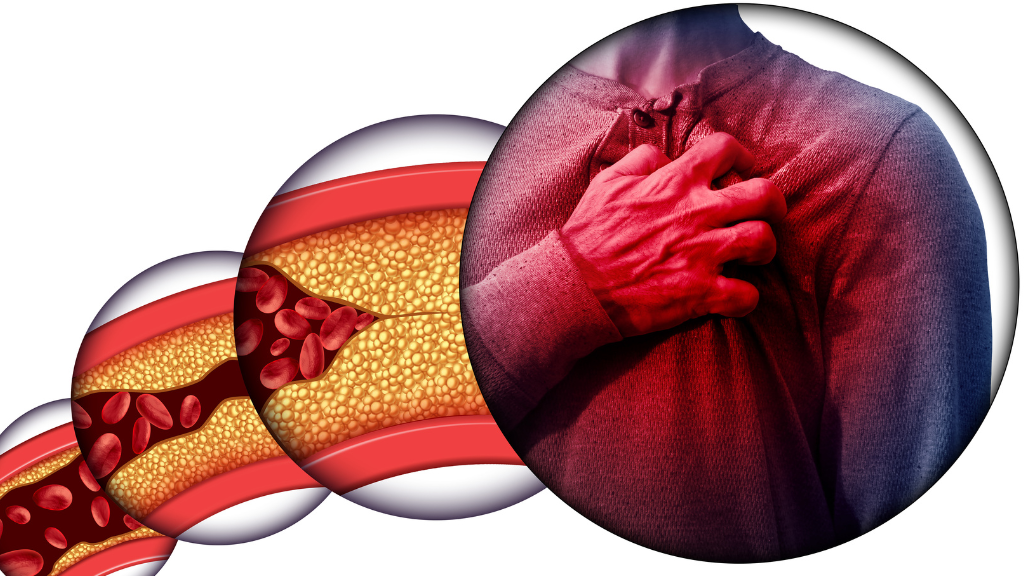 Sự cân bằng giữa HDL và LDL quyết định trực tiếp đến sức khỏe tim mạch