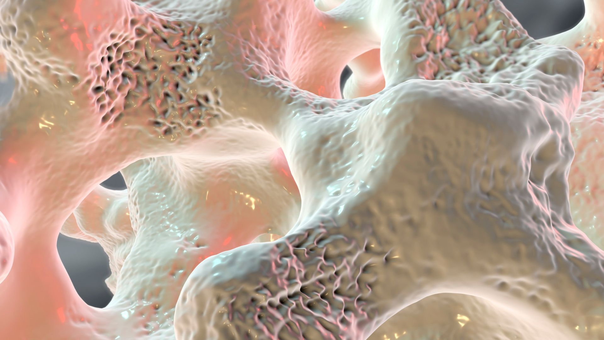 Loãng xương là một bệnh lý thường gặp ở hệ xương