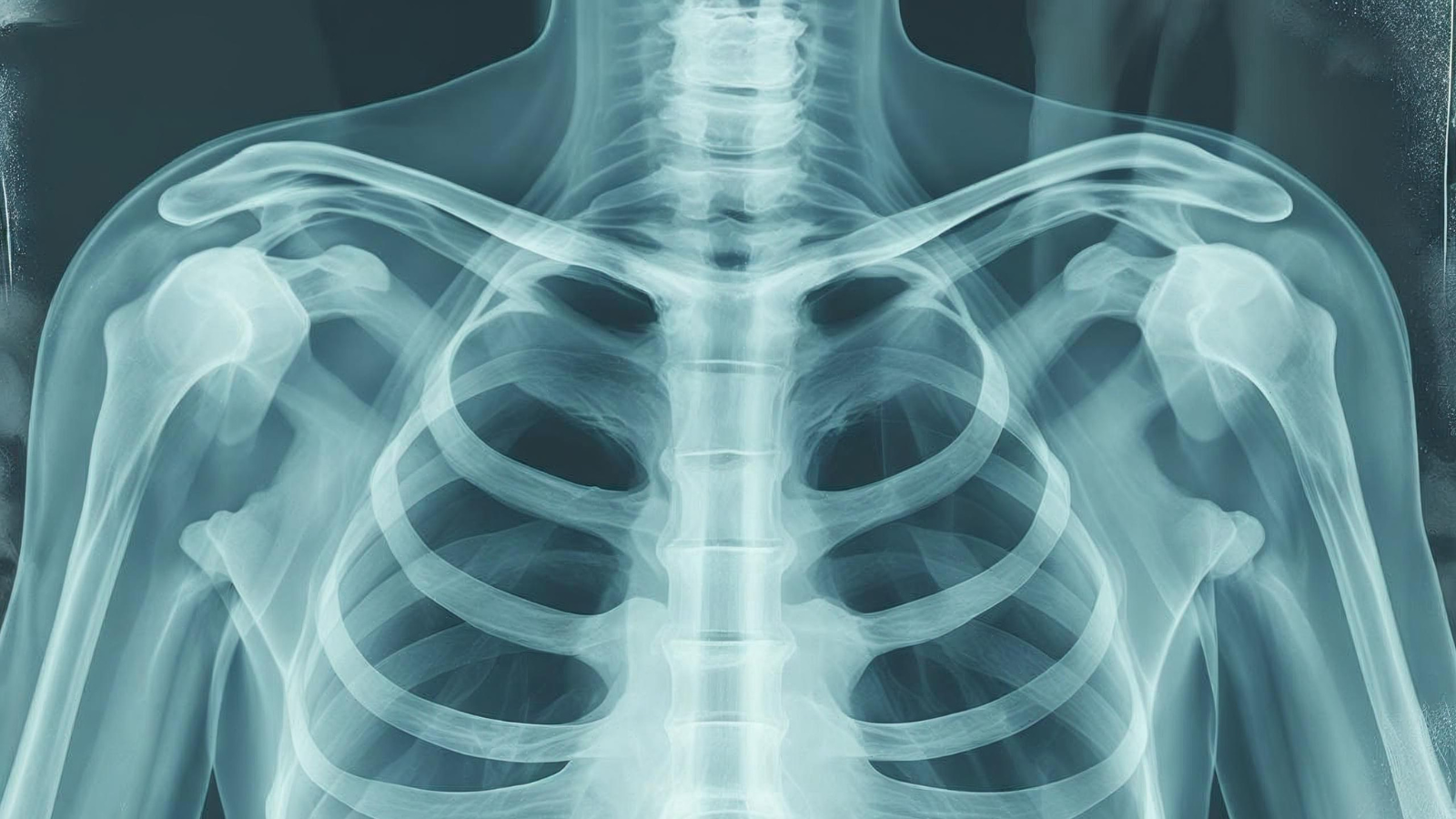 Hiểu rõ gãy xương sườn bao lâu thì lành giúp người bệnh kiên trì điều trị