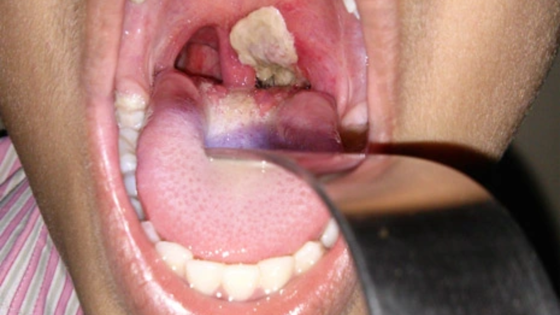 Hình ảnh bệnh bạch hầu giai đoạn toàn phát