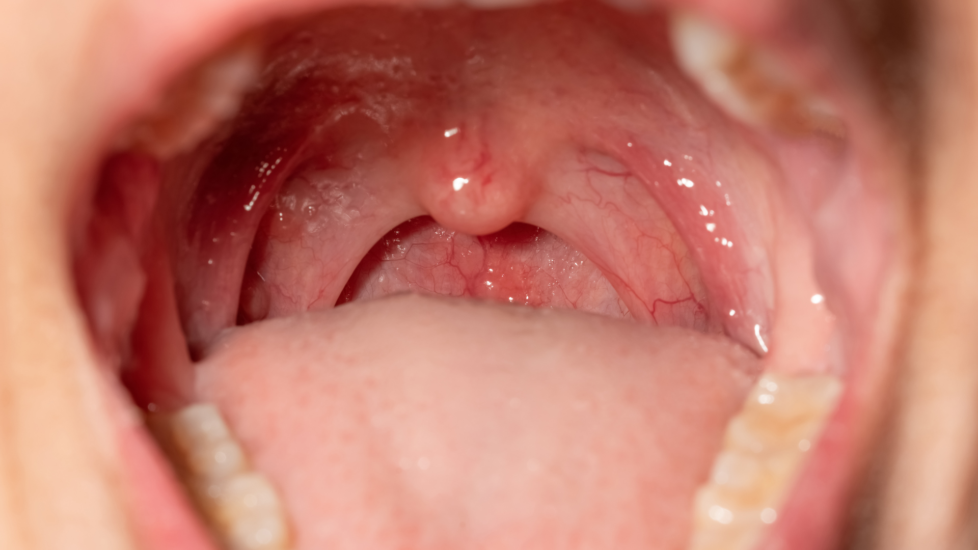 Giai đoạn hồi phục, giả mạc bong dần và tổn thương tại chỗ cải thiện