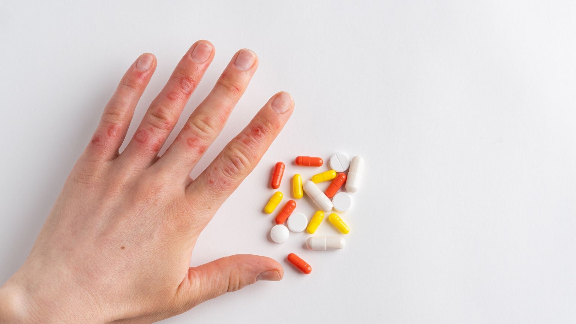 Hình ảnh bệnh lupus ban đỏ: Nhận diện dấu hiệu và chăm sóc đúng cách 3