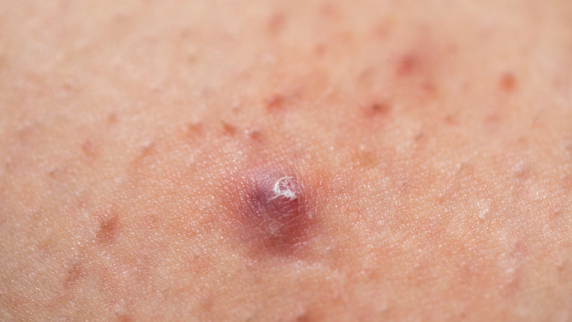 Bệnh ổ gà ở nách dễ bị nhầm lẫn với bệnh viêm nang lông