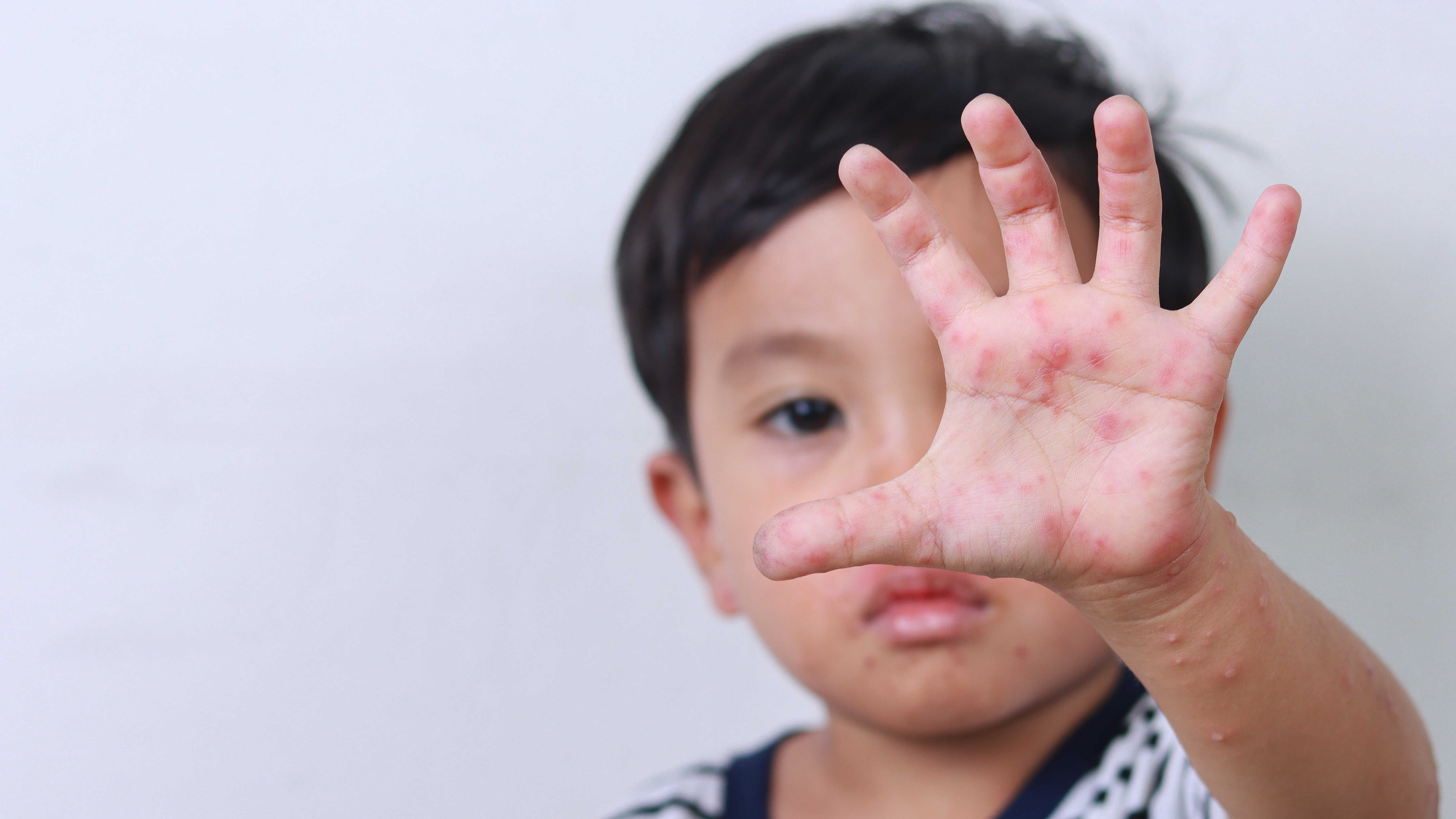 Hình ảnh bệnh tay chân miệng cấp độ 3: Dấu hiệu nhận biết và hướng xử lý kịp thời 3