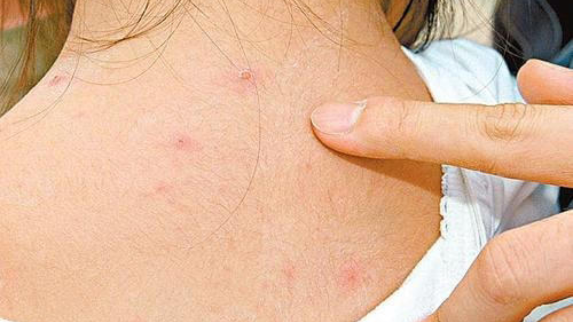 hinh-anh-benh-thuy-dau-o-tre-em-qua-tung-giai-doan-tien-trien-benh-2